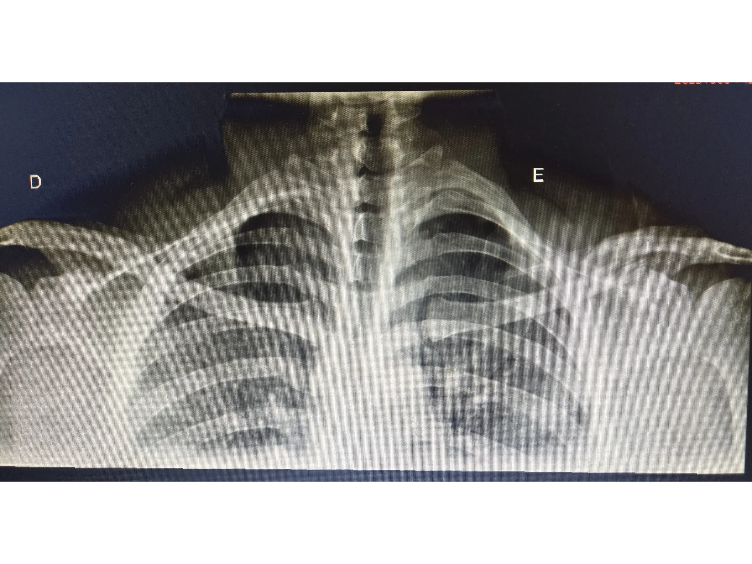 Fratura da Clavícula 02 - Técnica Minimamente Invasiva