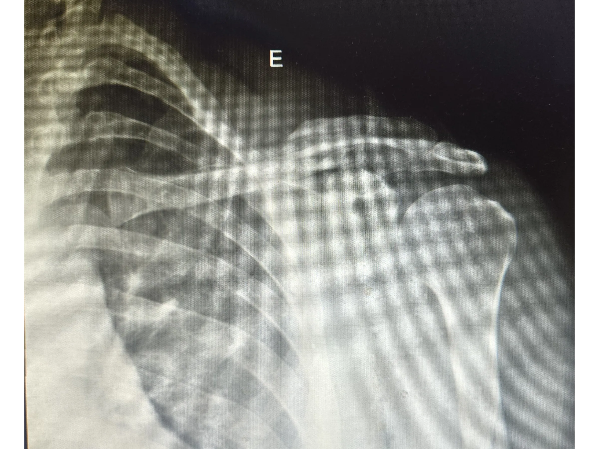 Fratura da Clavícula 02 - Técnica Minimamente Invasiva