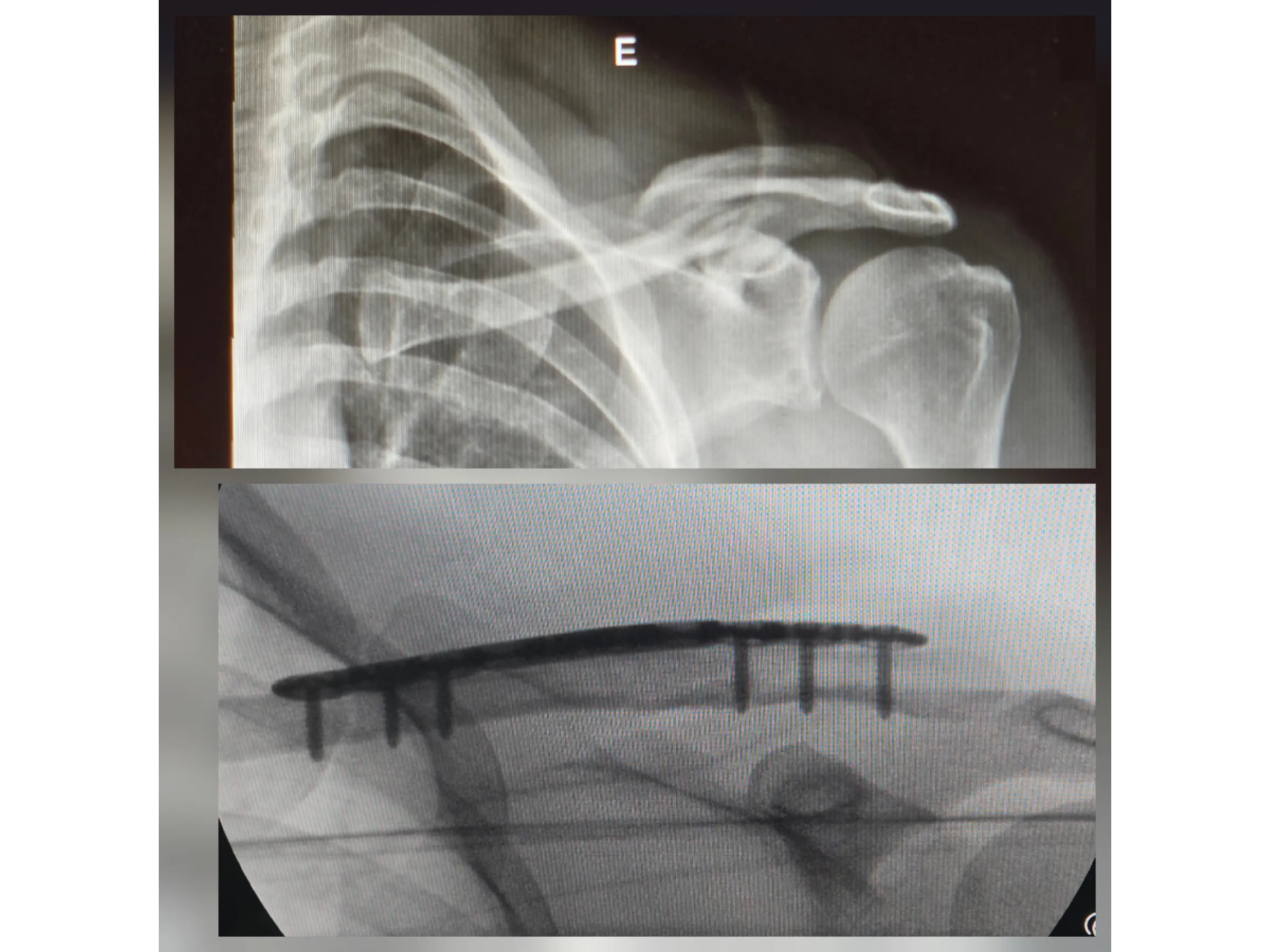 Fratura da Clavícula 02 - Técnica Minimamente Invasiva