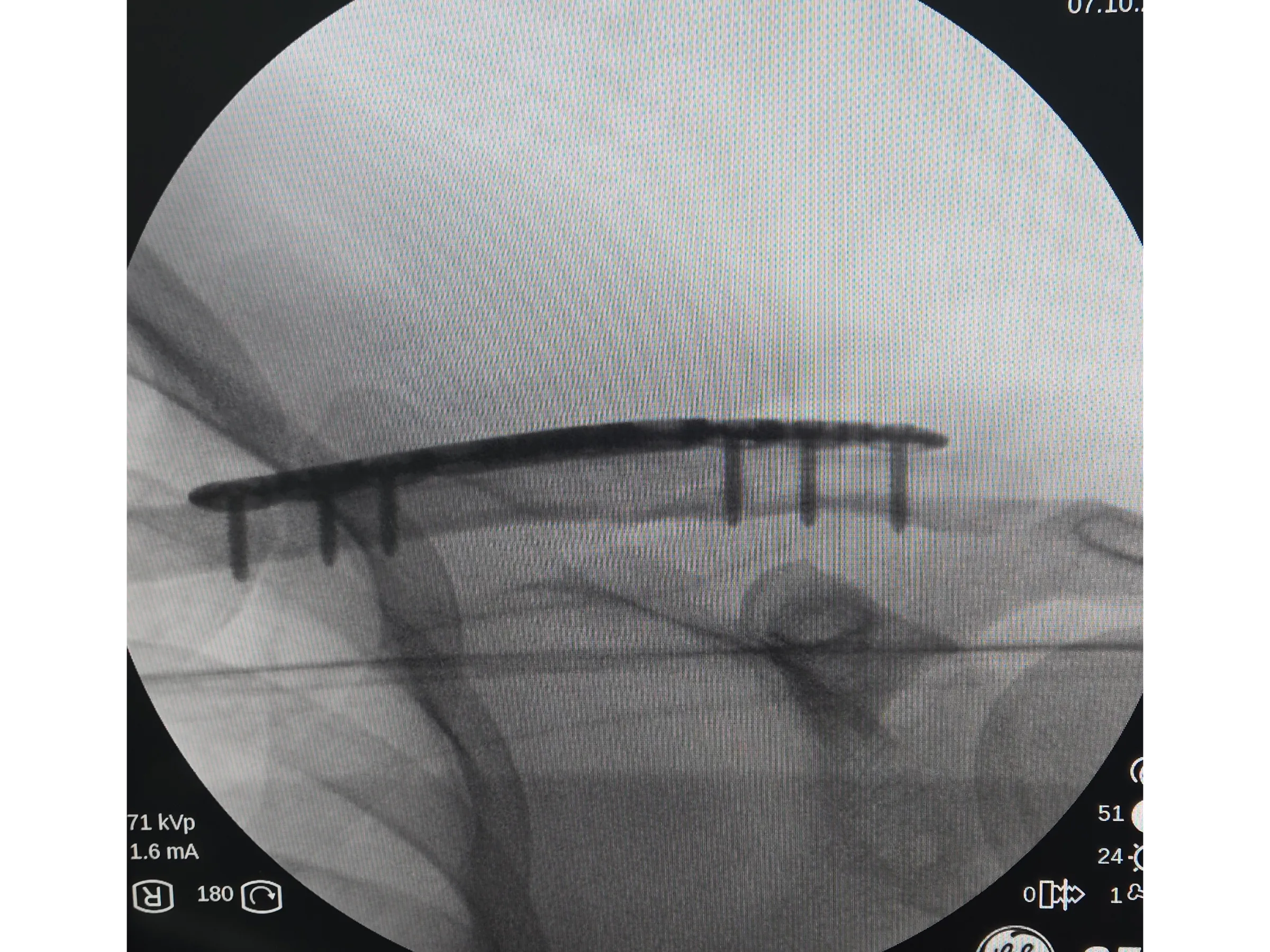 Fratura da Clavícula 02 - Técnica Minimamente Invasiva