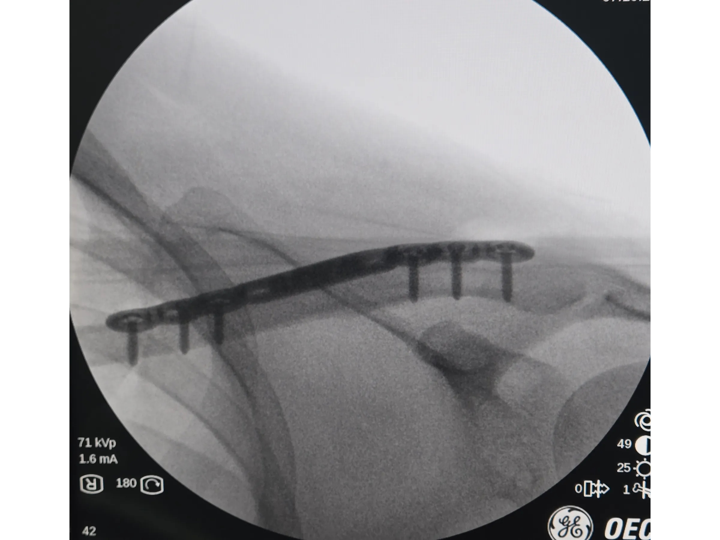 Fratura da Clavícula 02 - Técnica Minimamente Invasiva