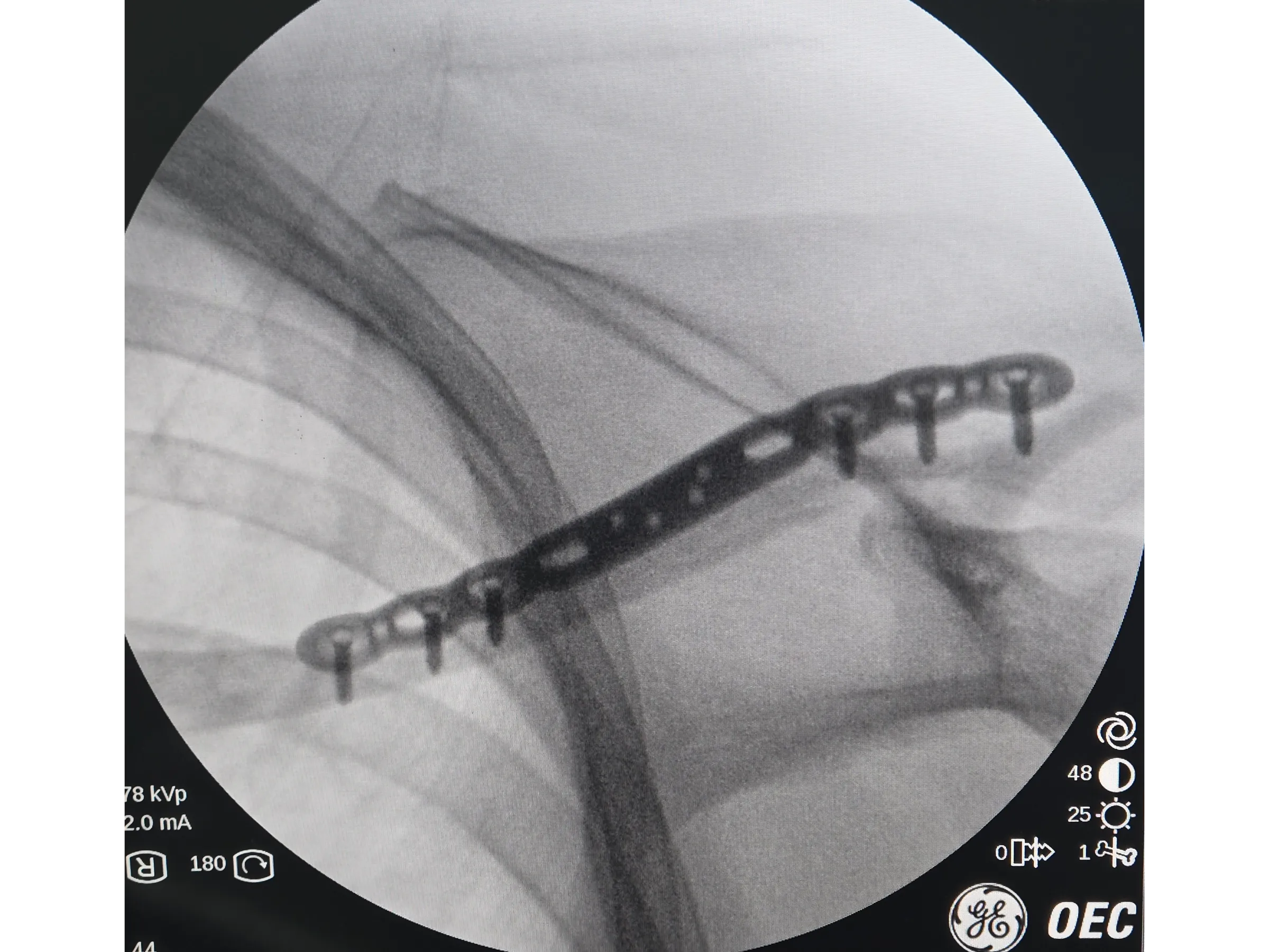 Fratura da Clavícula 02 - Técnica Minimamente Invasiva