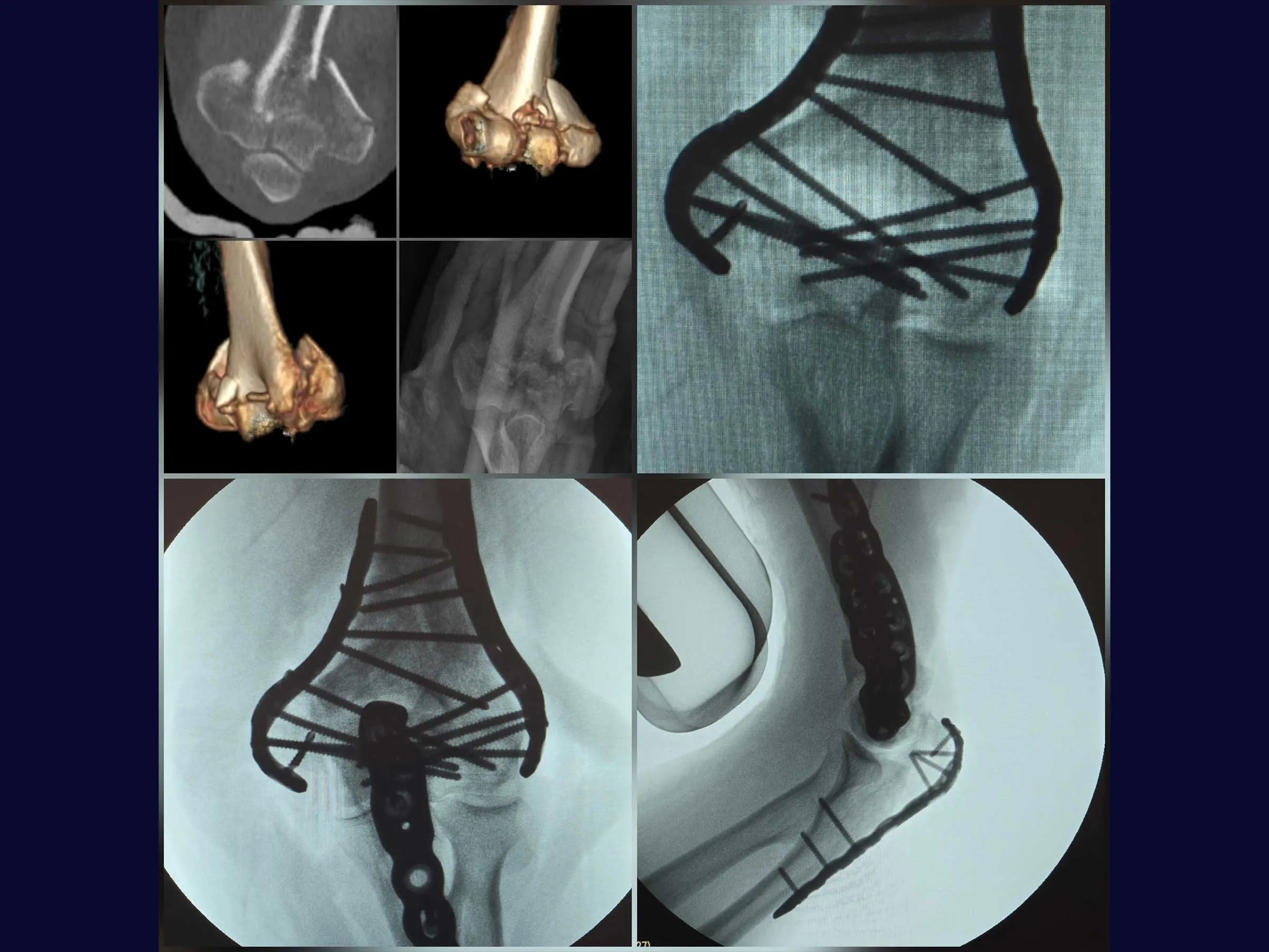 Fratura Articular Cominutiva do Úmero Distal