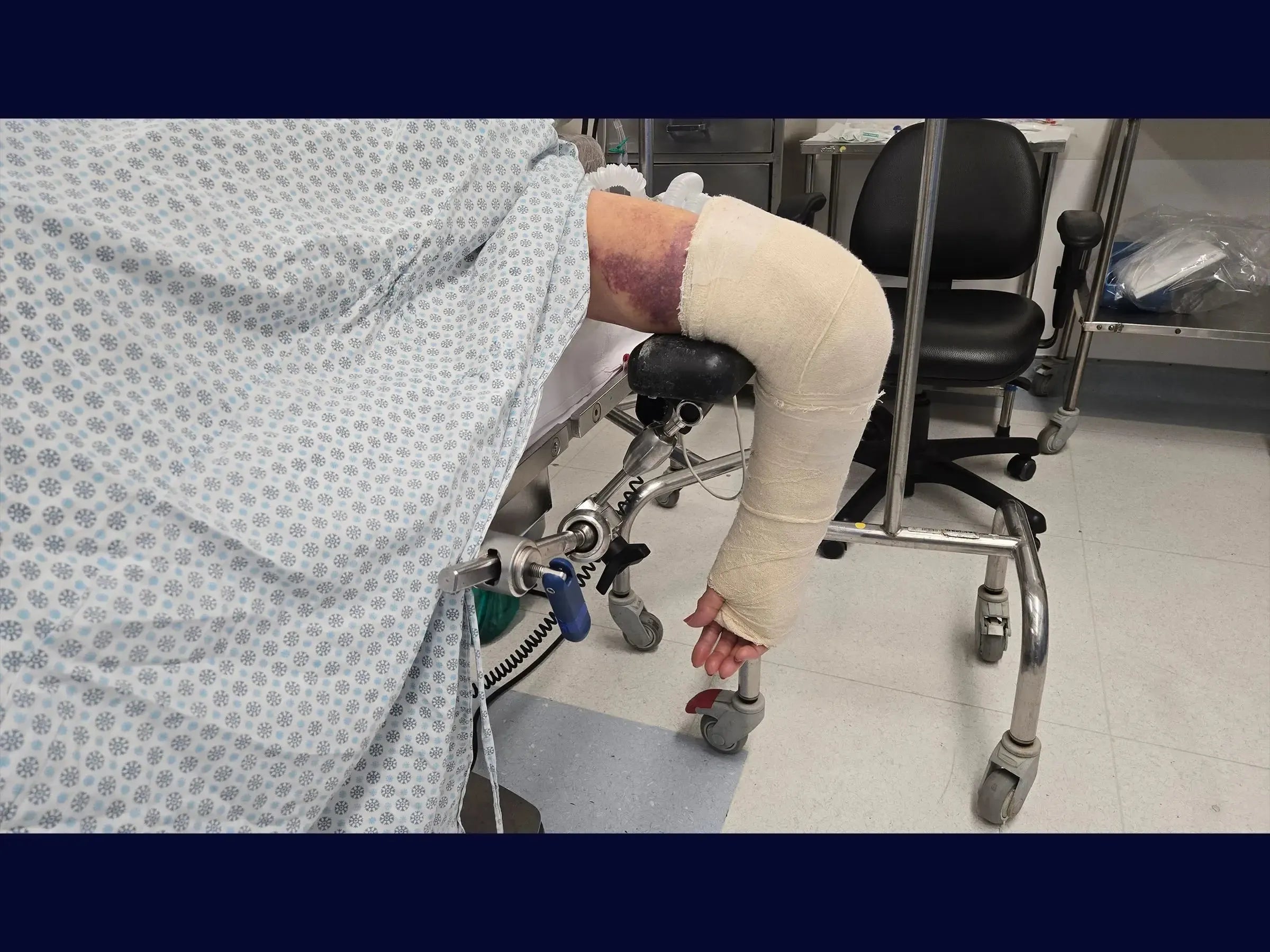 Comminuted Articular Fracture of the Distal Humerus