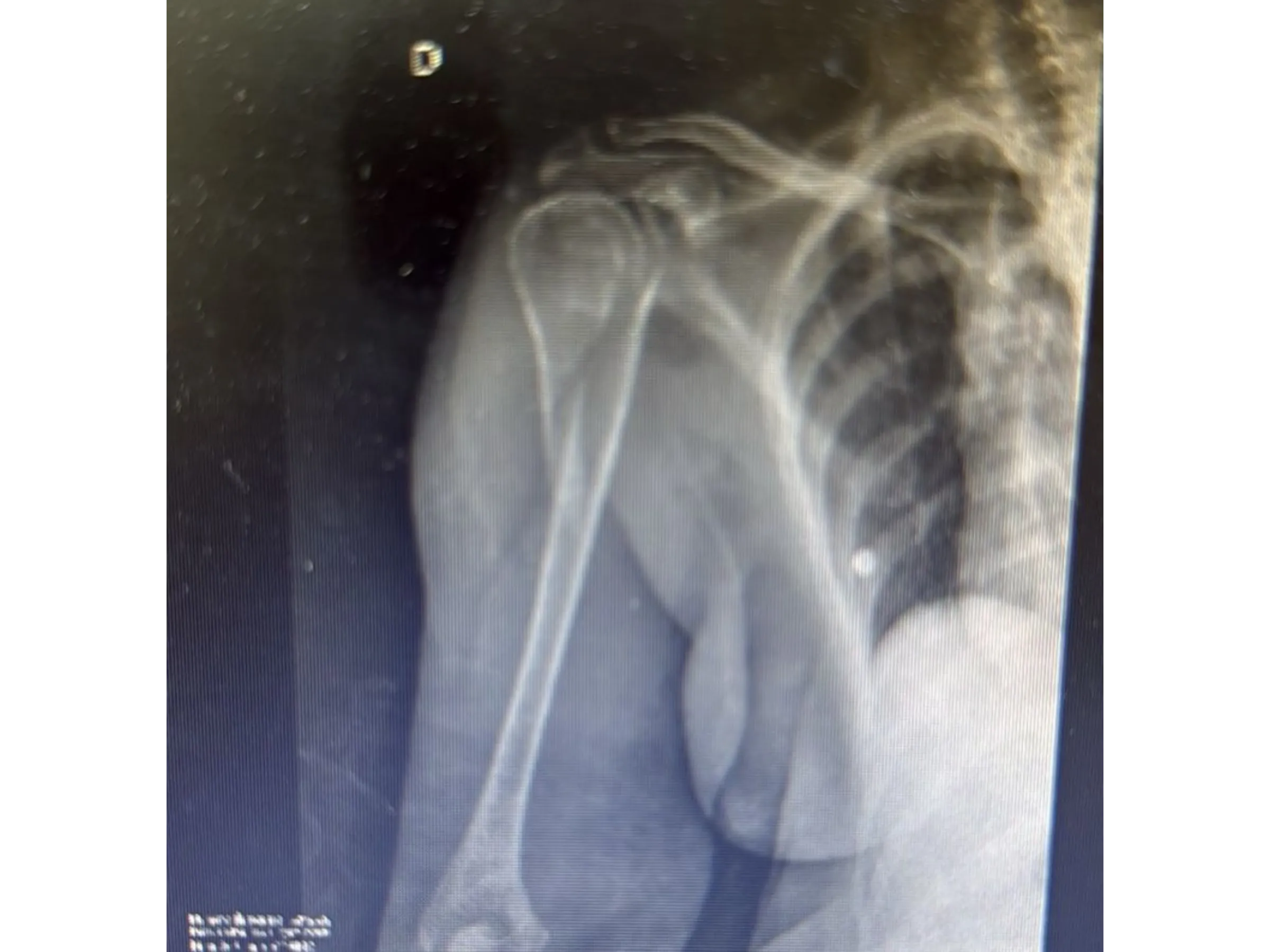 Intramedullary Nail for Proximal Humerus (03)