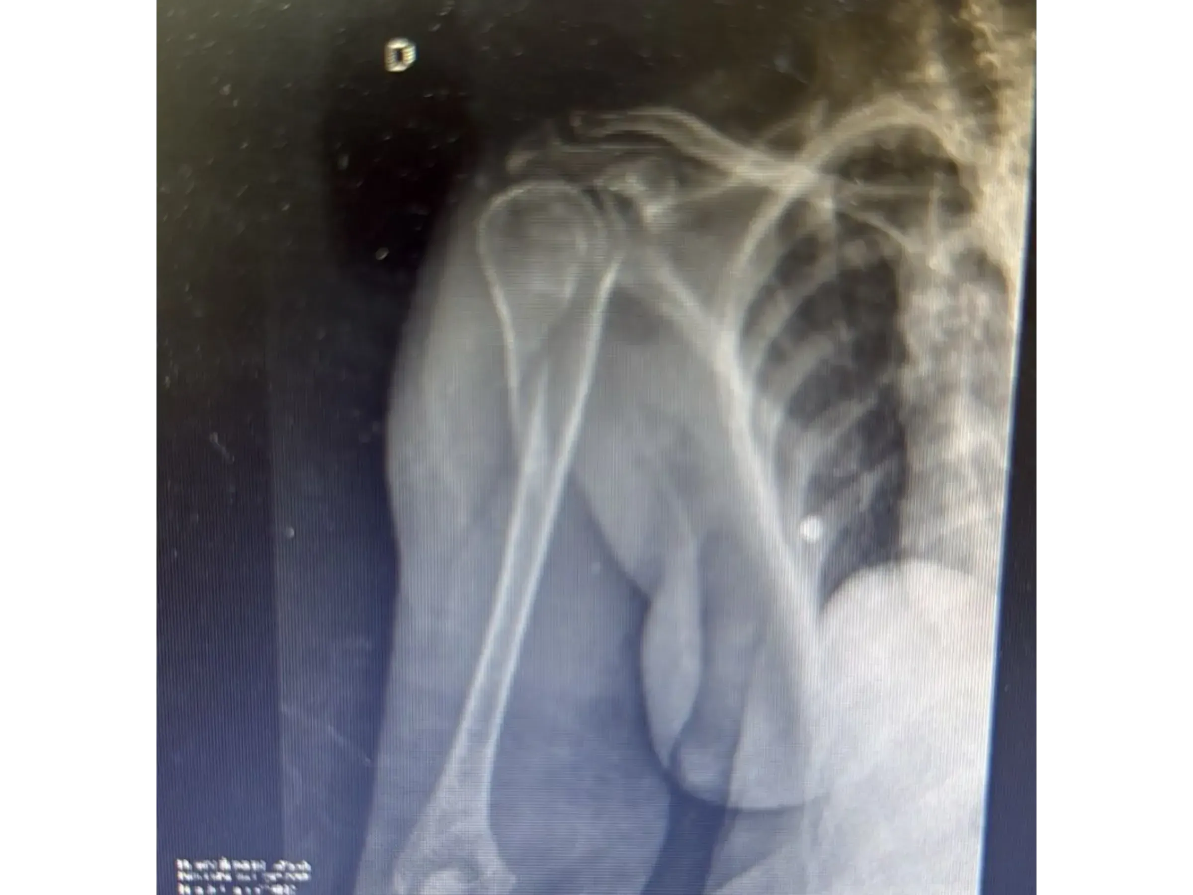 Haste Intramedular para Úmero Proximal (03)