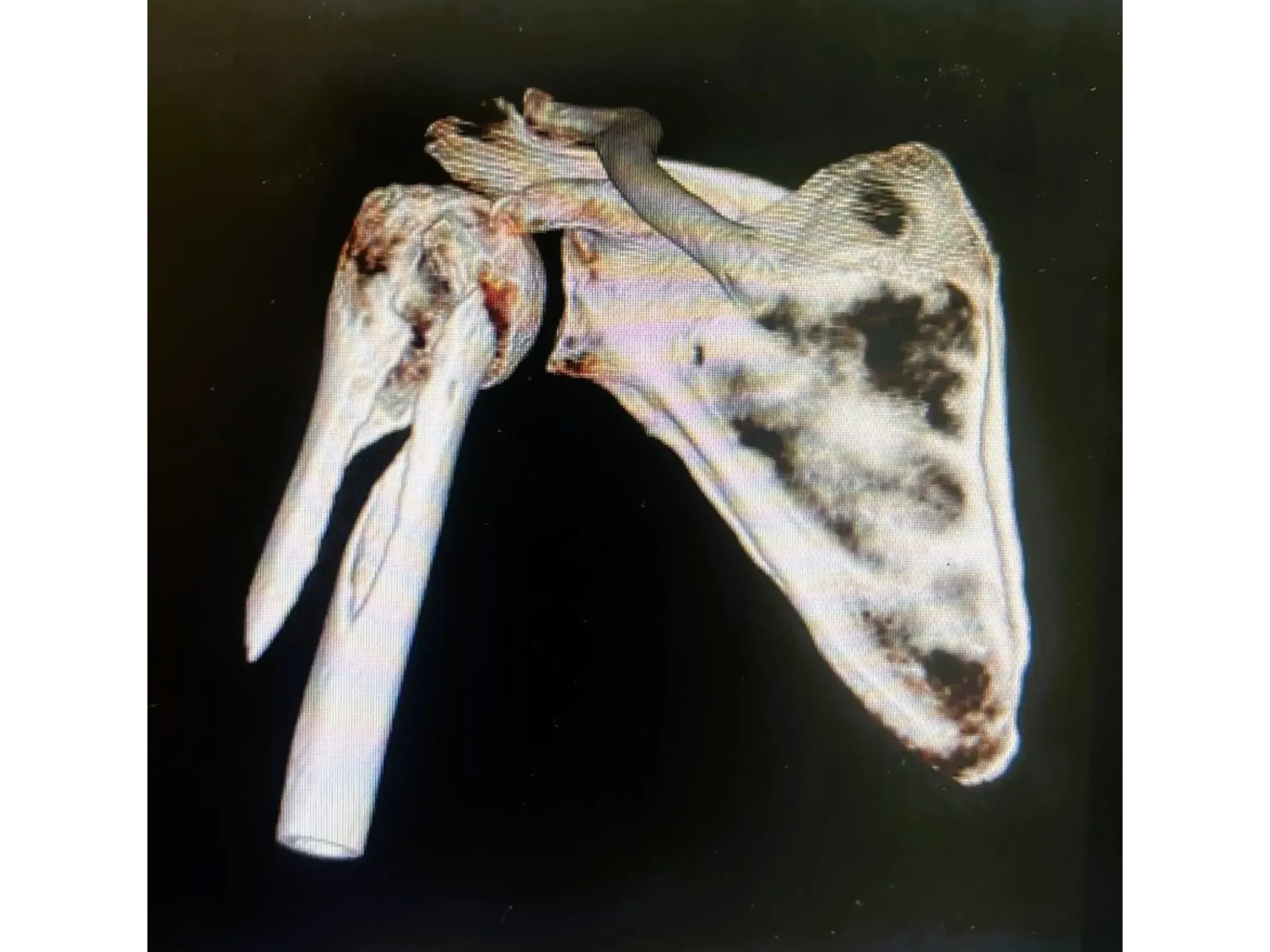 Haste Intramedular para Úmero Proximal (03)