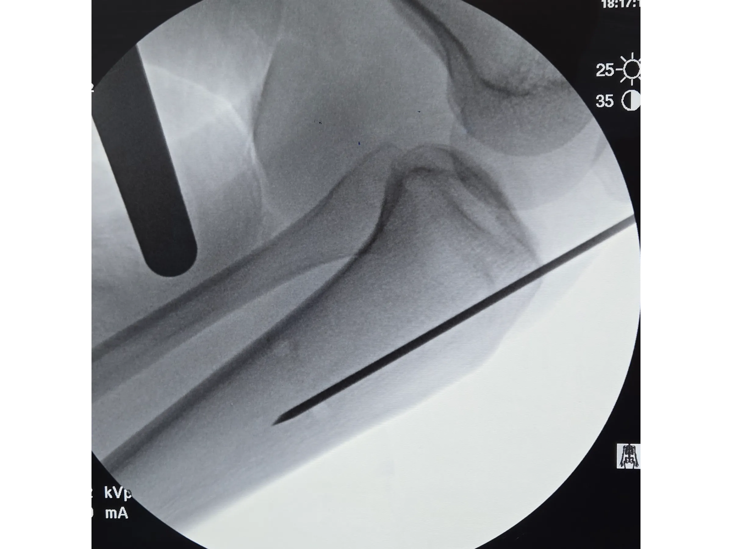 Haste Intramedular da Tíbia - Abordagem Infra-Patelar