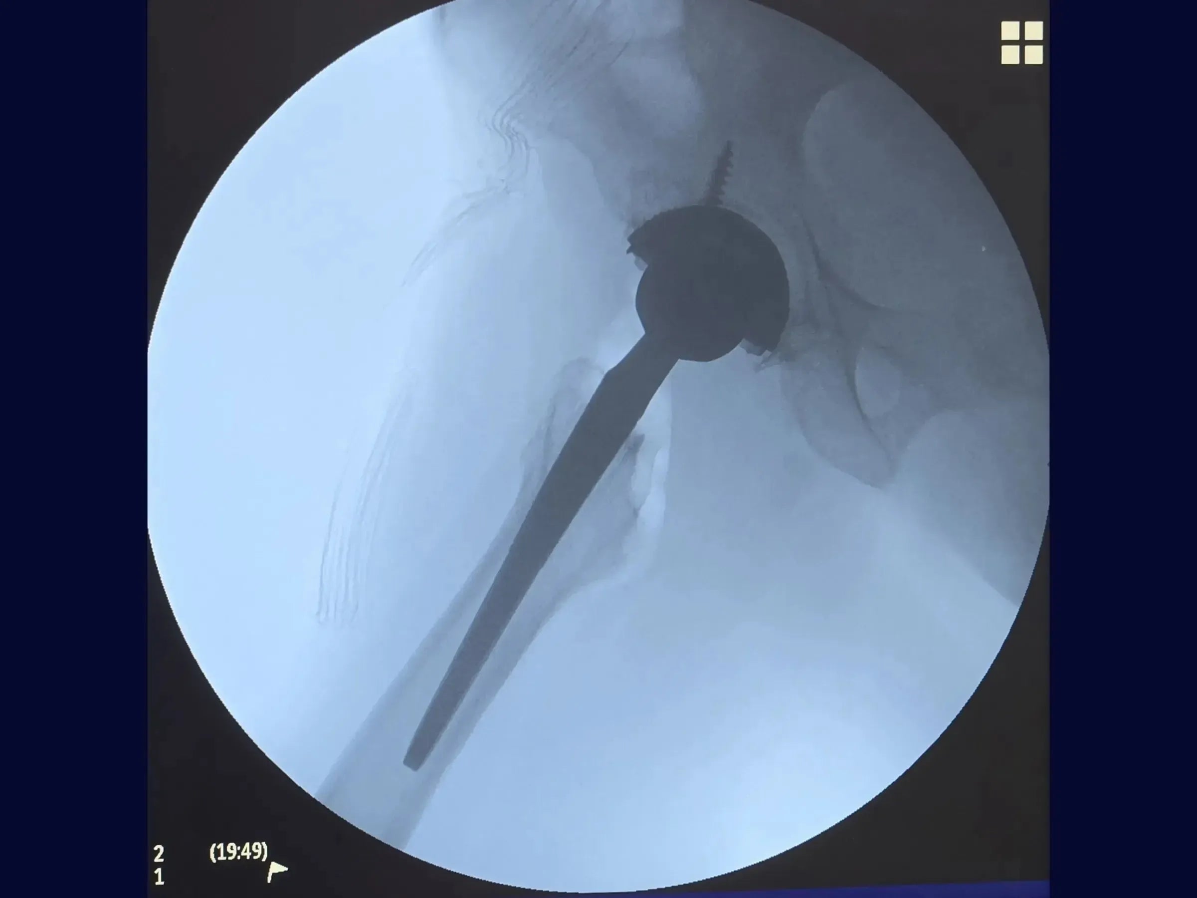 Artroplastia Total Do Quadril - Abordagem Posterior