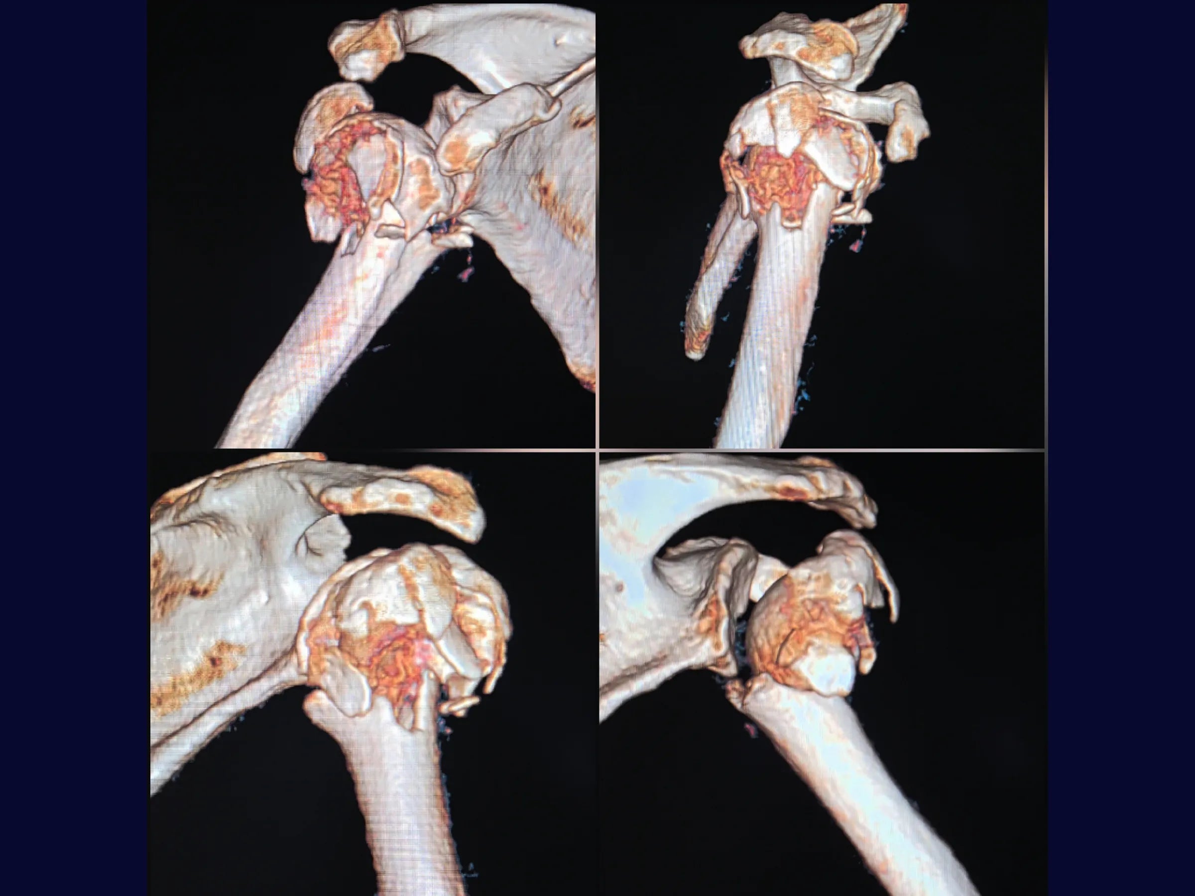 Úmero Proximal – Fratura em 4 Partes