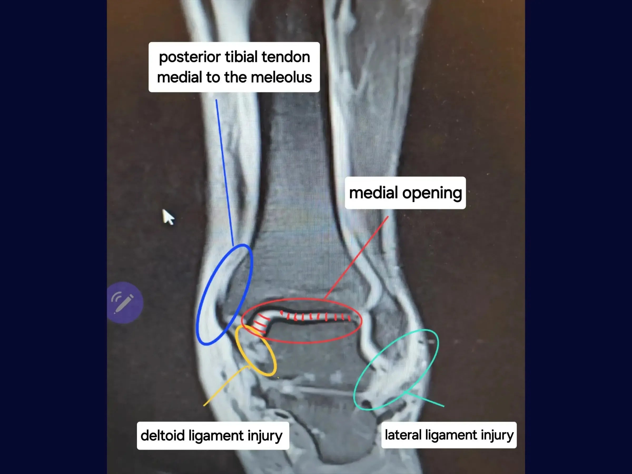 360-Degree Reconstruction for Complex Ankle Injuries (Achilles Tendon, Posterior Tibial, and Ligamentous Injuries)