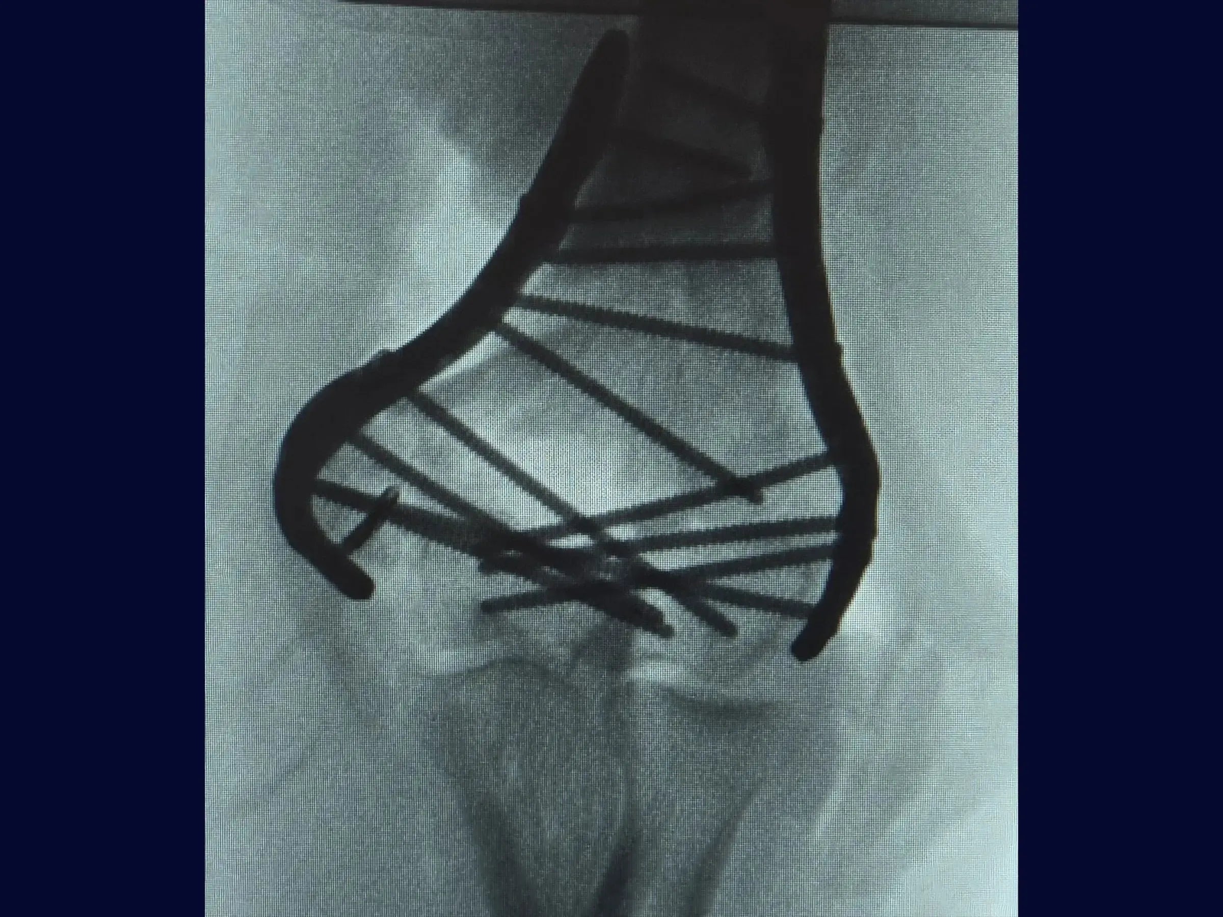 Comminuted Articular Fracture of the Distal Humerus