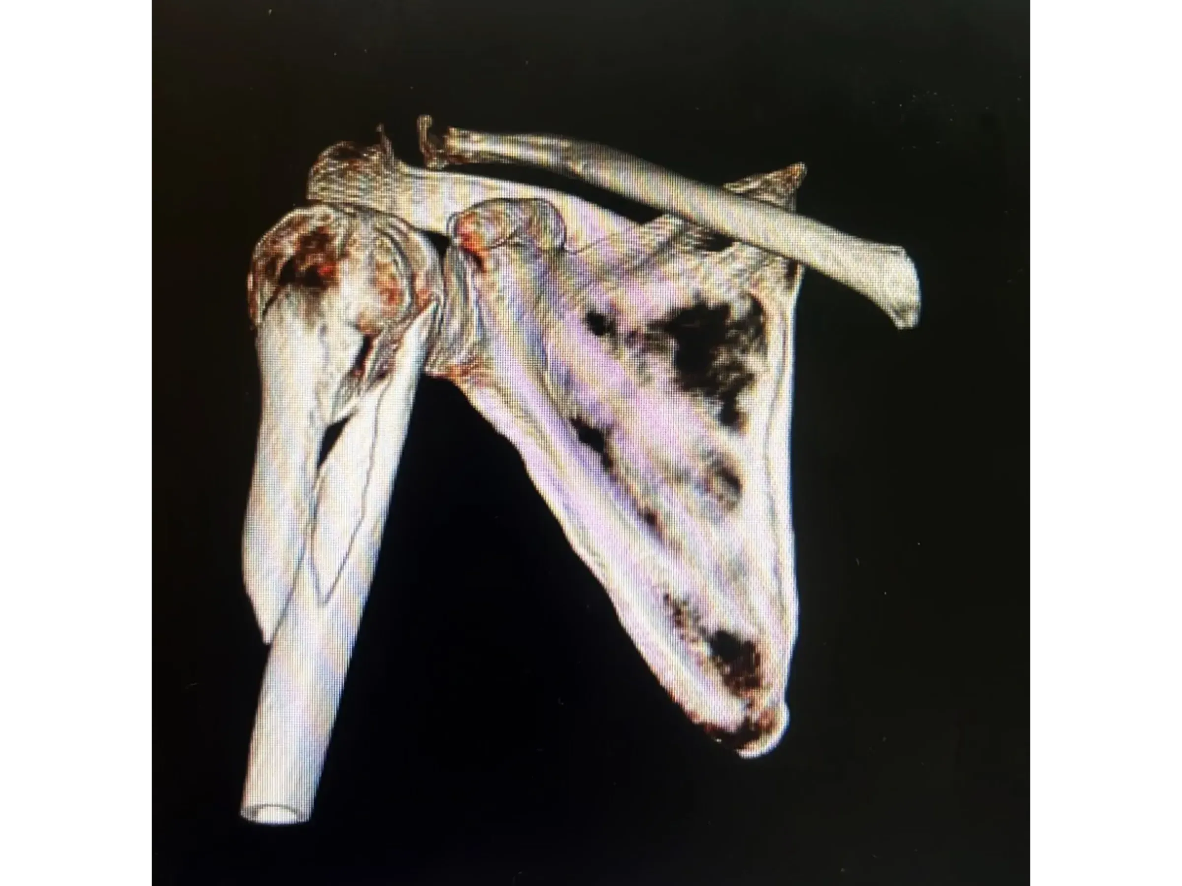 Haste Intramedular para Úmero Proximal (03)