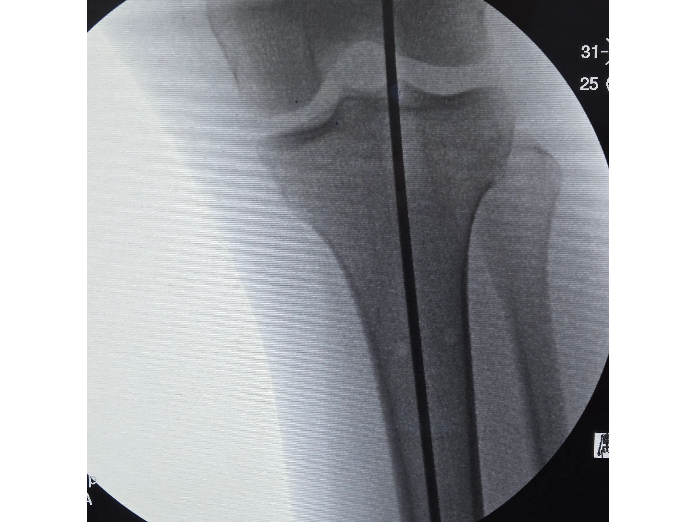 Haste Intramedular da Tíbia - Abordagem Infra-Patelar