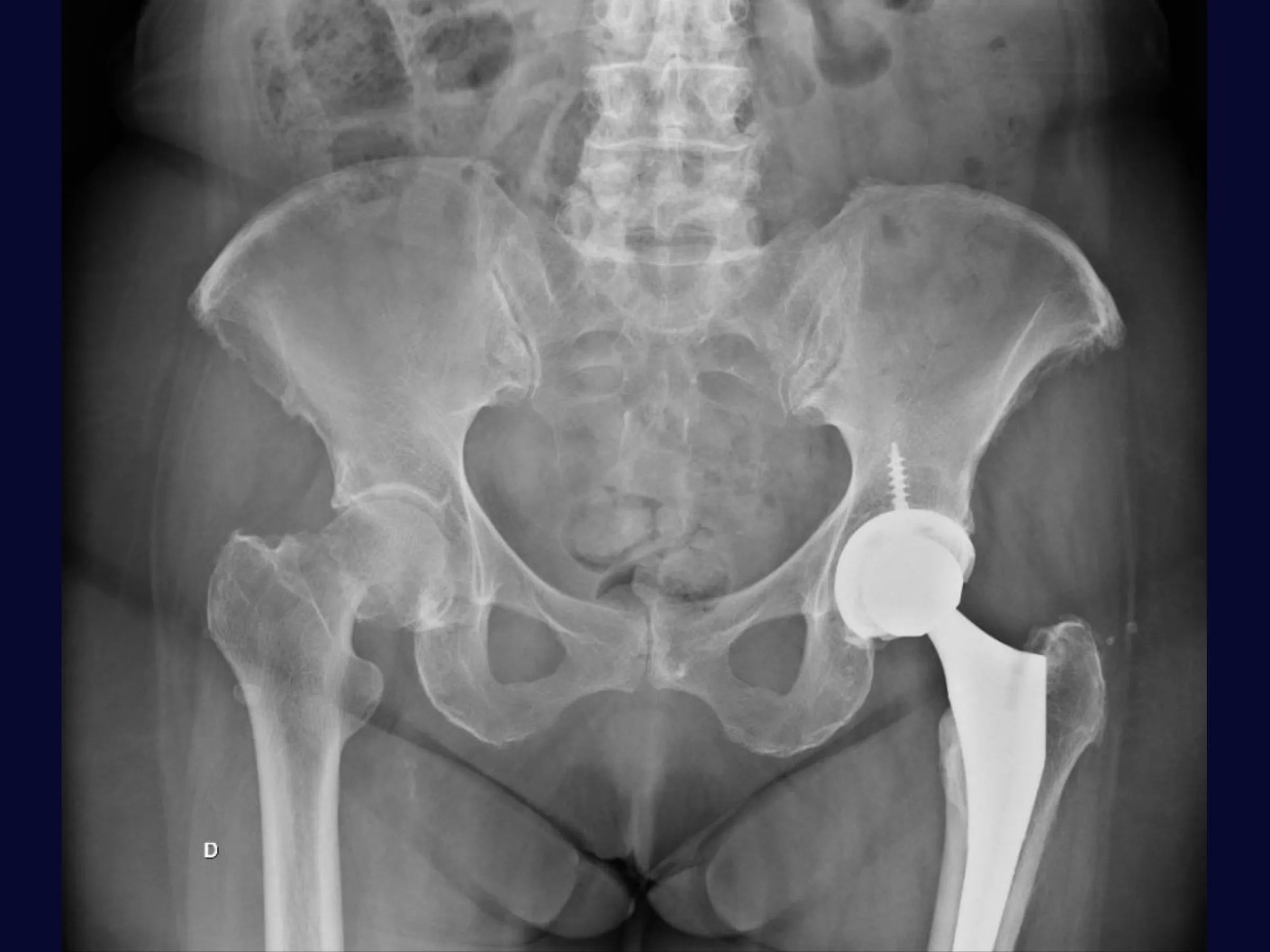 Artroplastia Total Do Quadril - Abordagem Posterior
