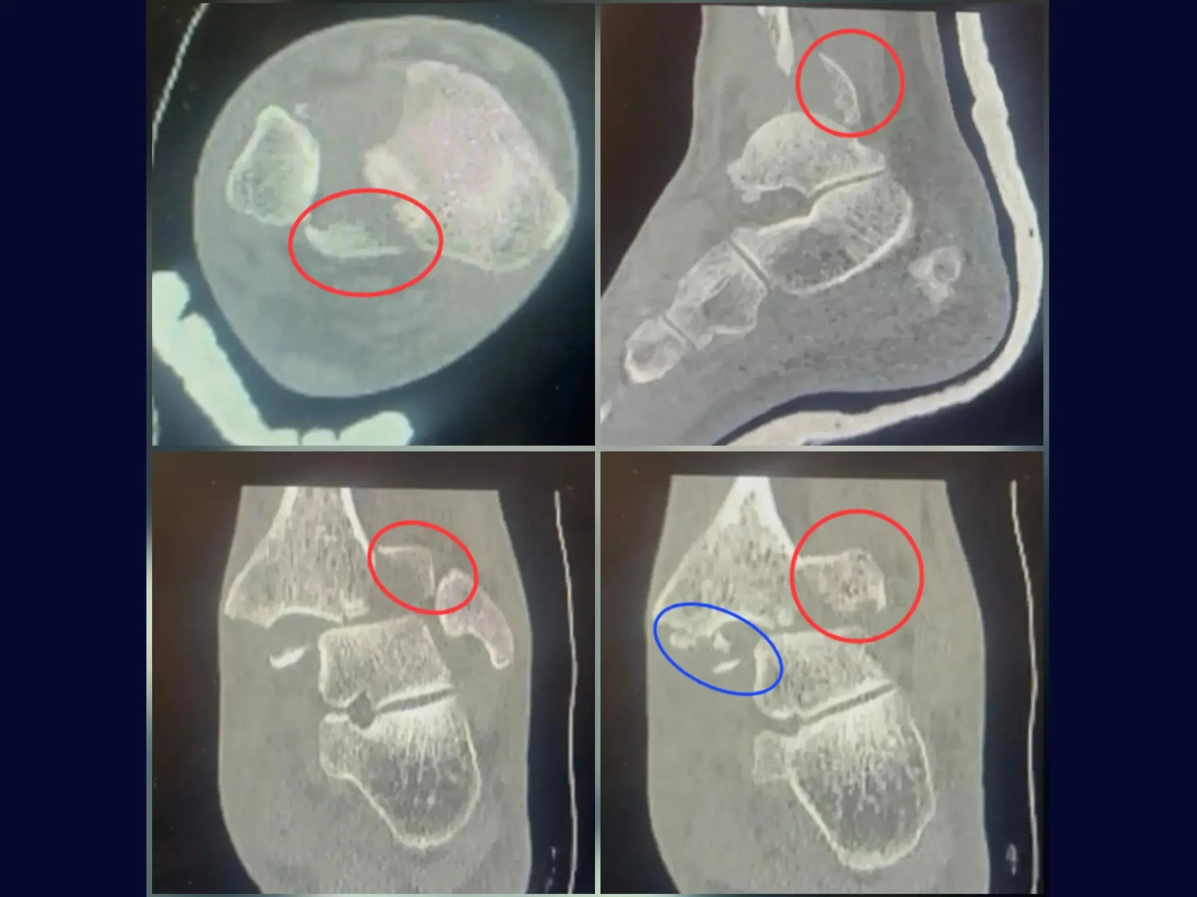 Fratura Trimaleolar - Abordagem em Decúbito Lateral