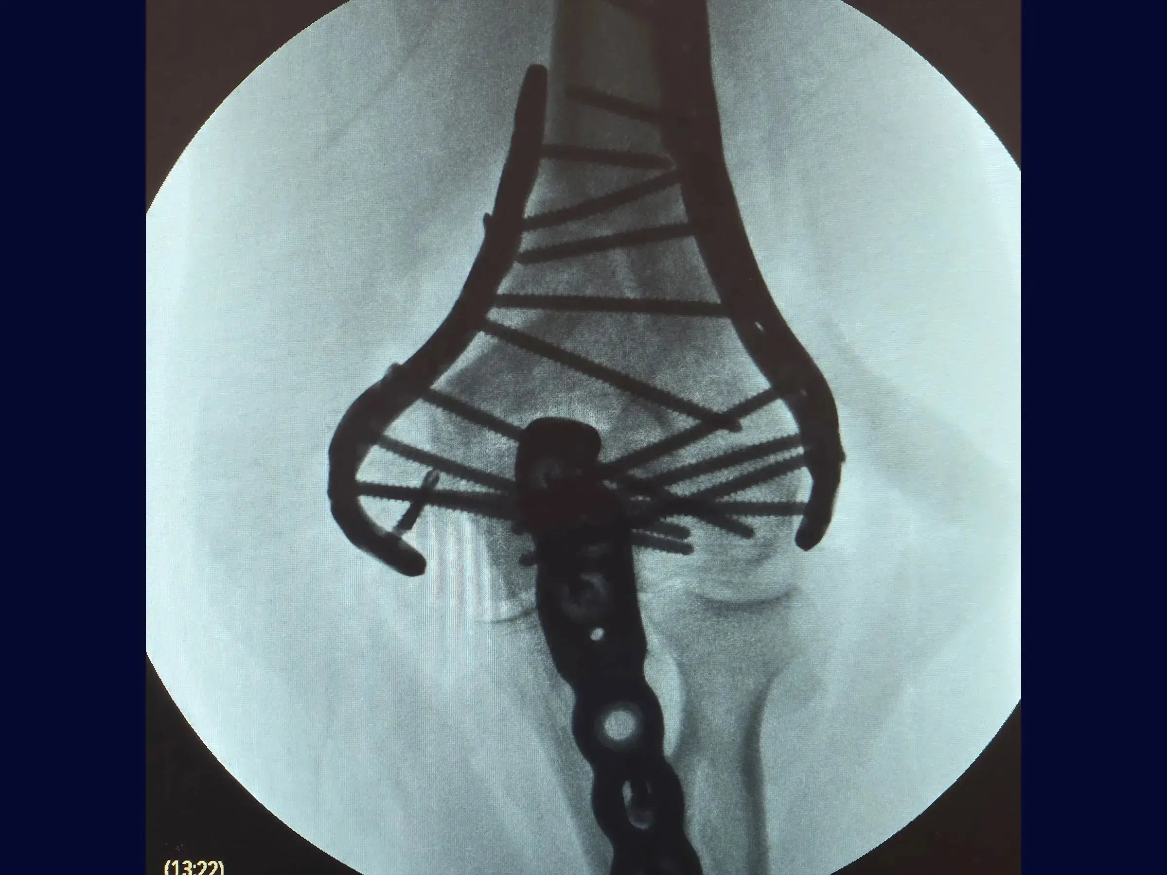 Comminuted Articular Fracture of the Distal Humerus