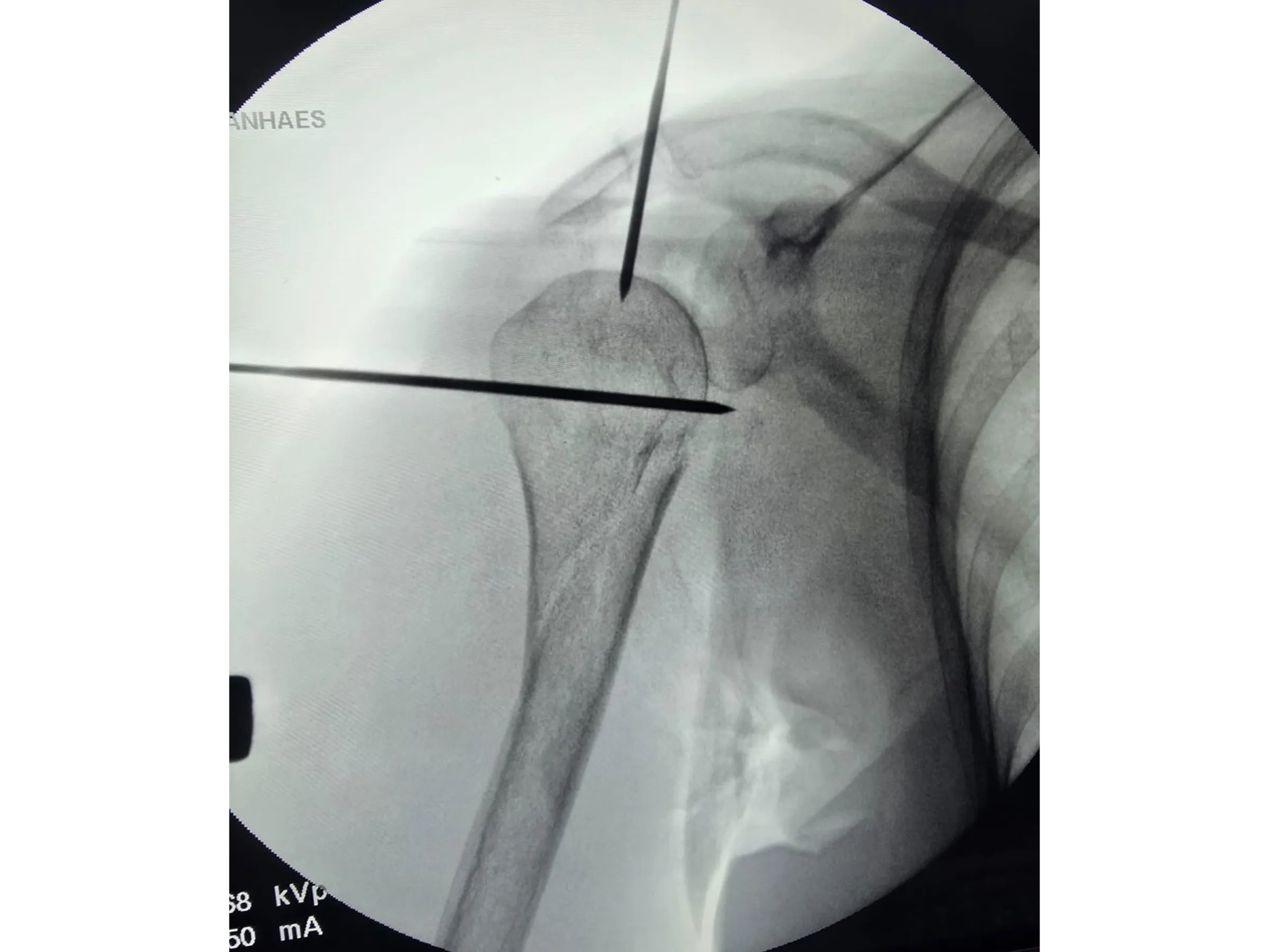 Intramedullary Nail for Proximal Humerus (03)