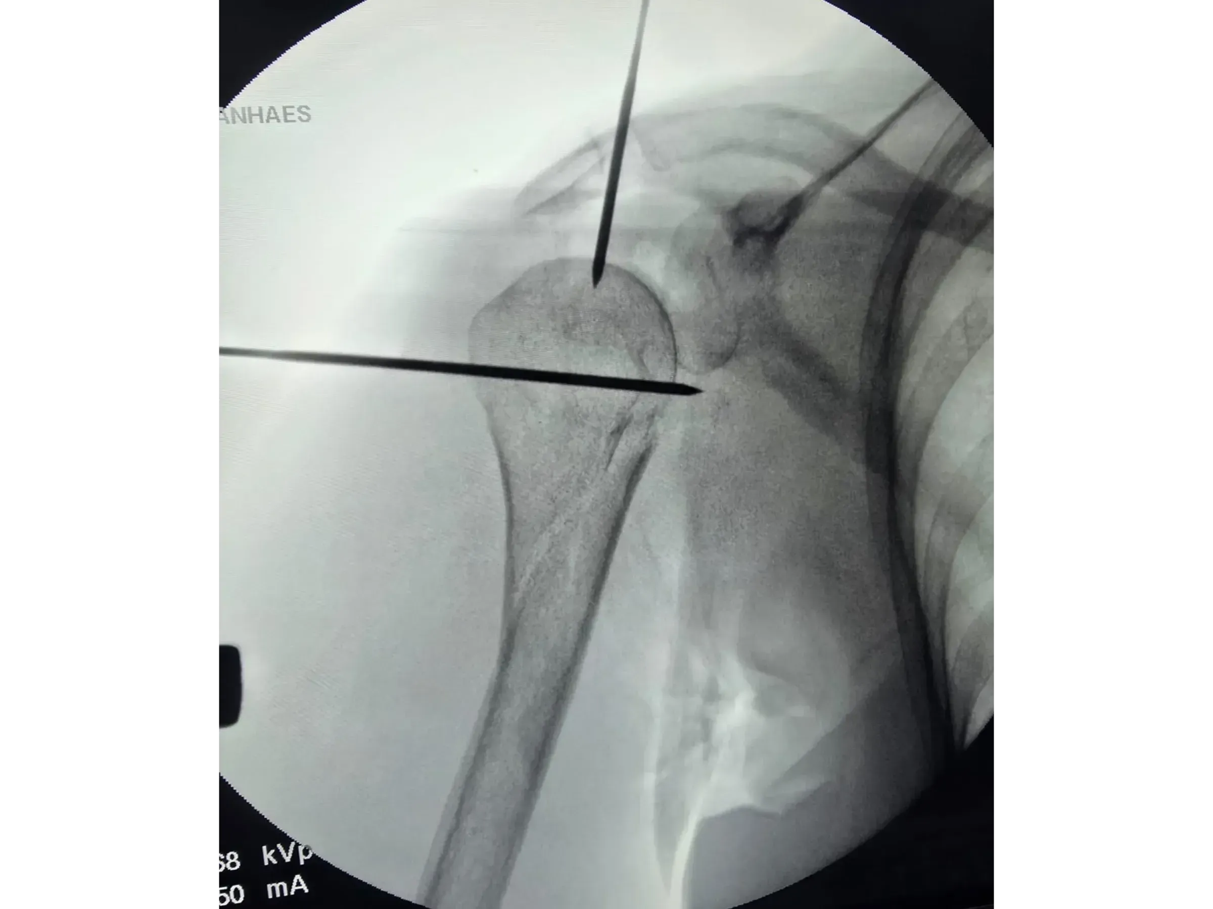 Haste Intramedular para Úmero Proximal (03)