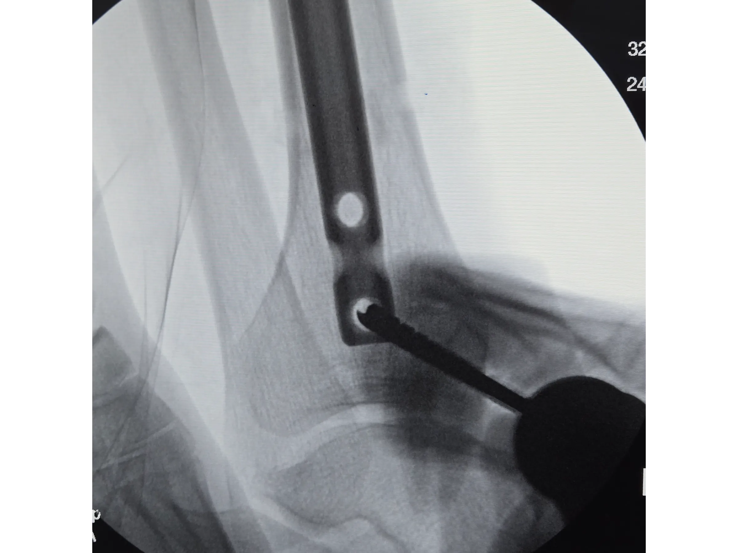 Haste Intramedular da Tíbia - Abordagem Infra-Patelar