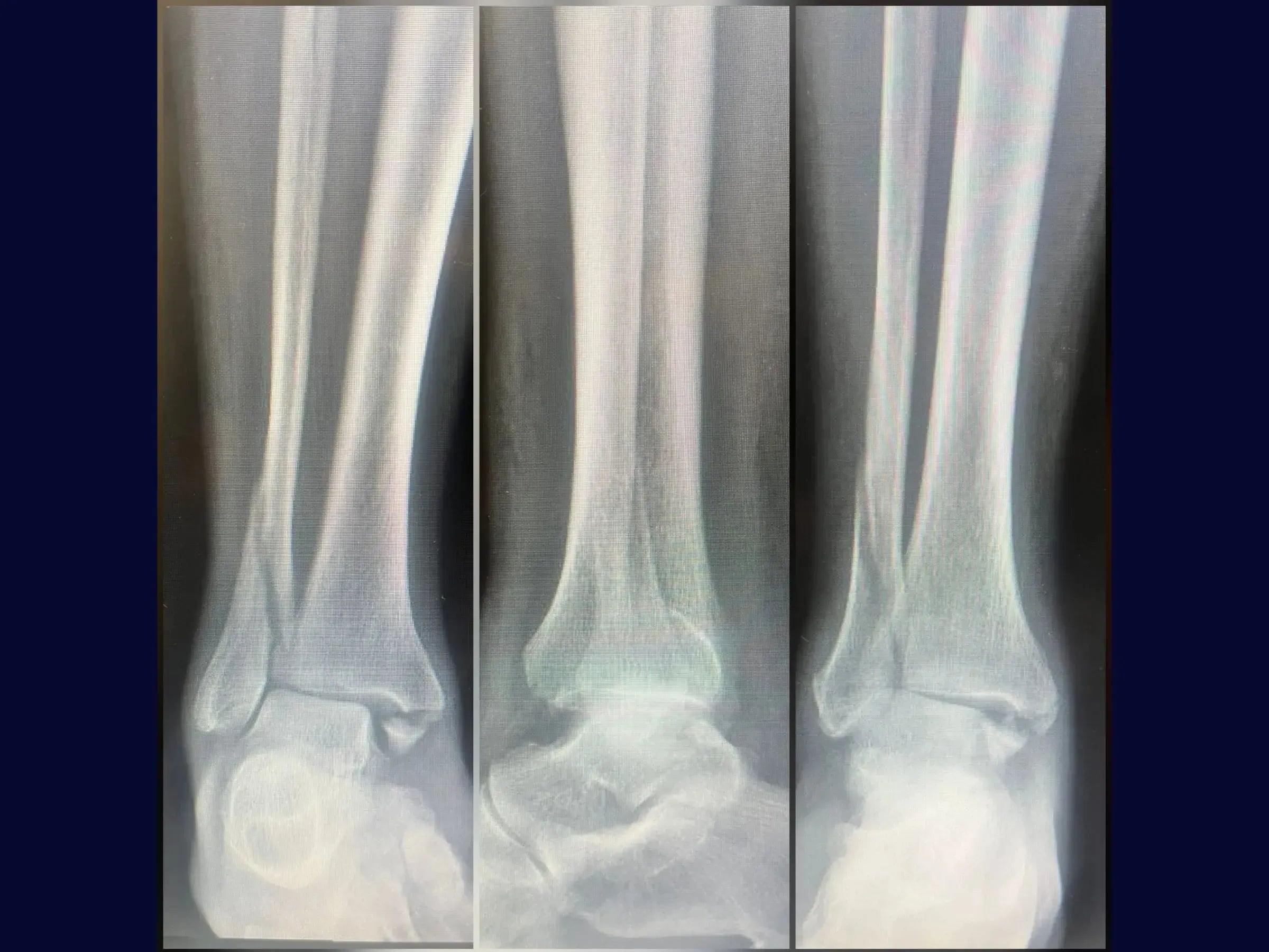 Fratura Trimaleolar - Abordagem em Decúbito Lateral