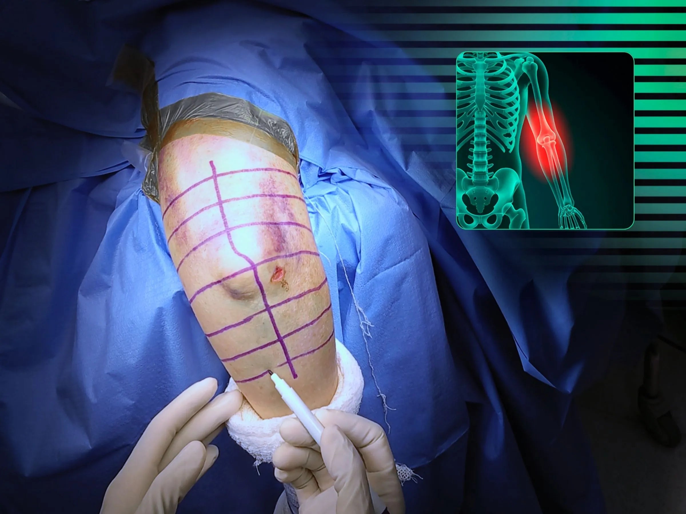 Fratura Articular Cominutiva do Úmero Distal