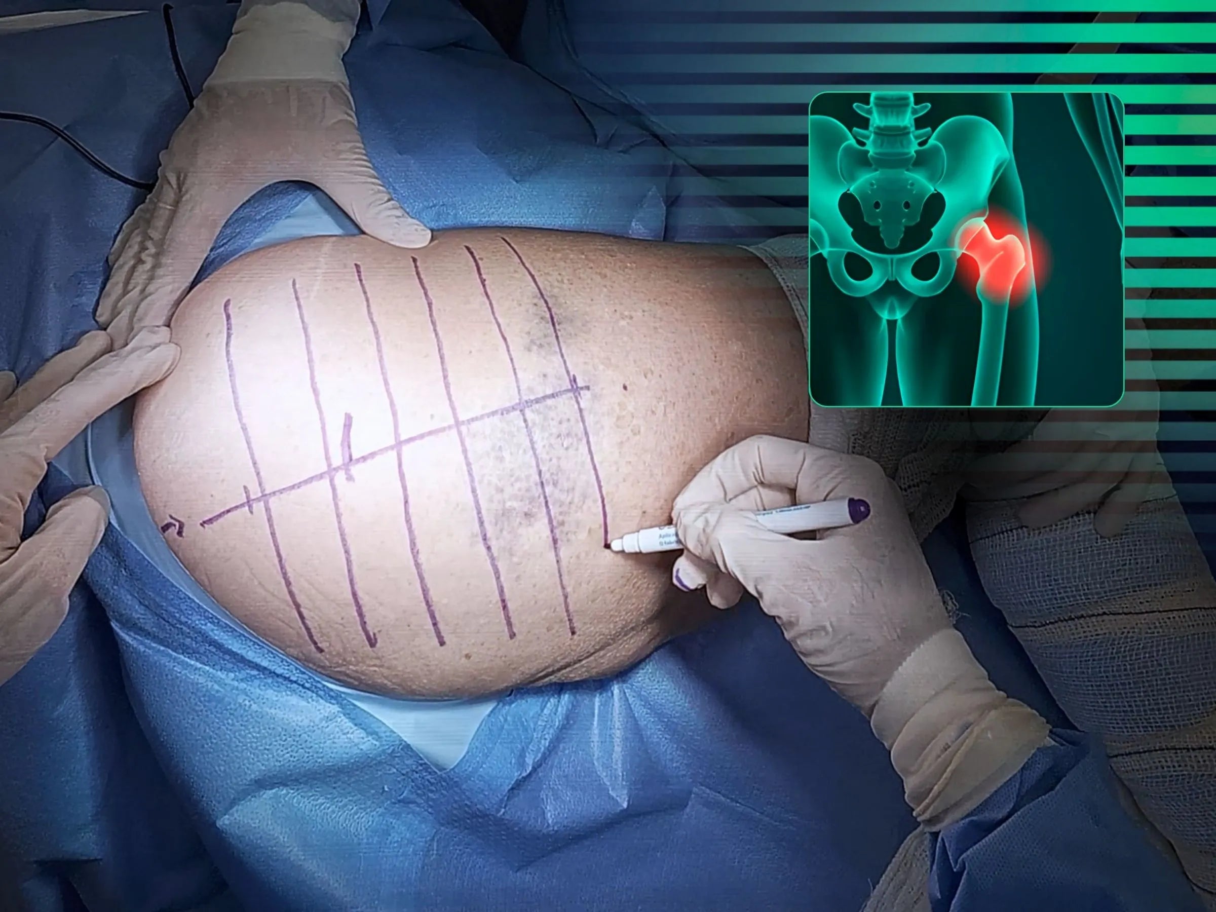 Artroplastia Total Do Quadril - Abordagem Posterior