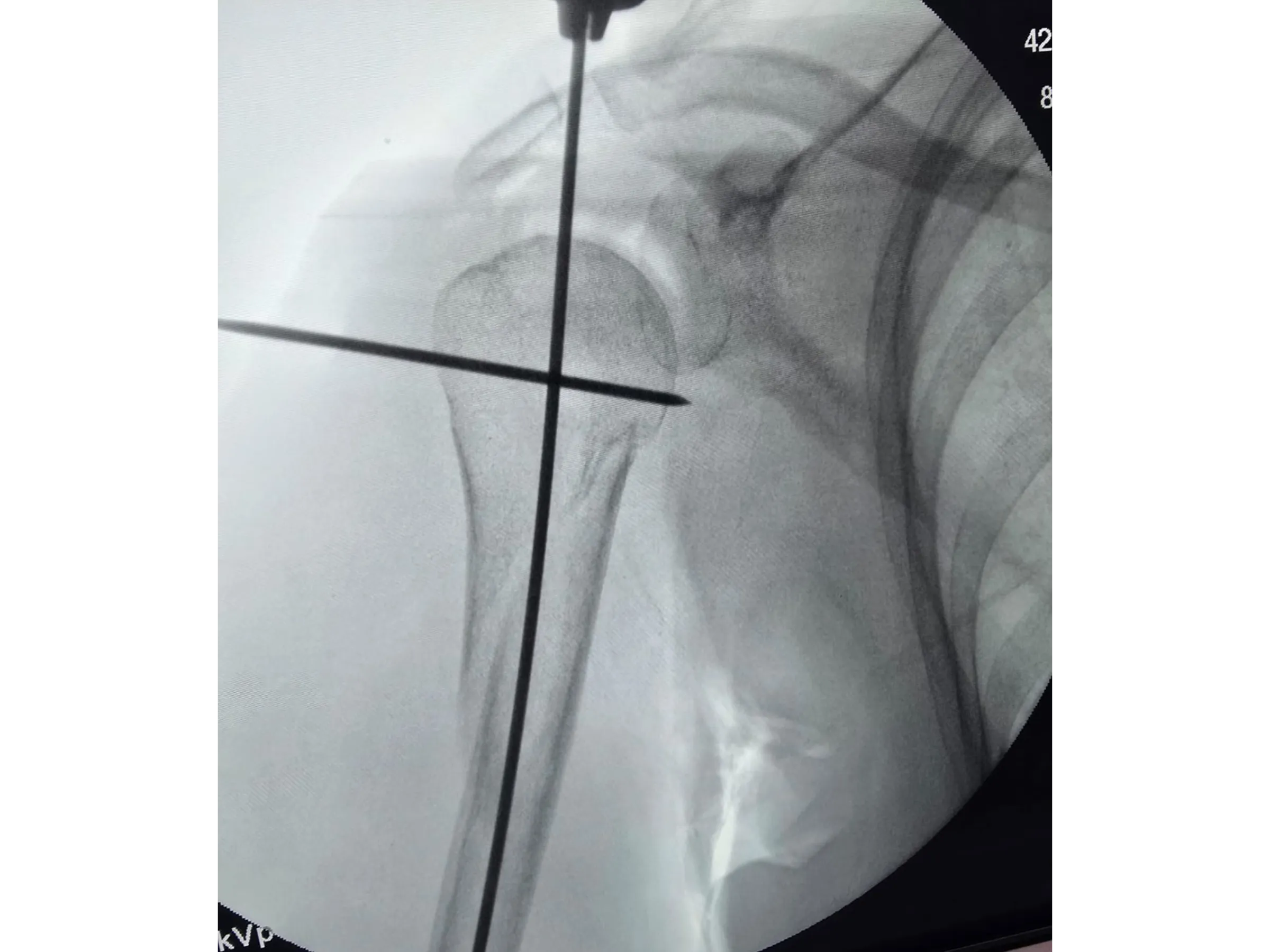Intramedullary Nail for Proximal Humerus (03)