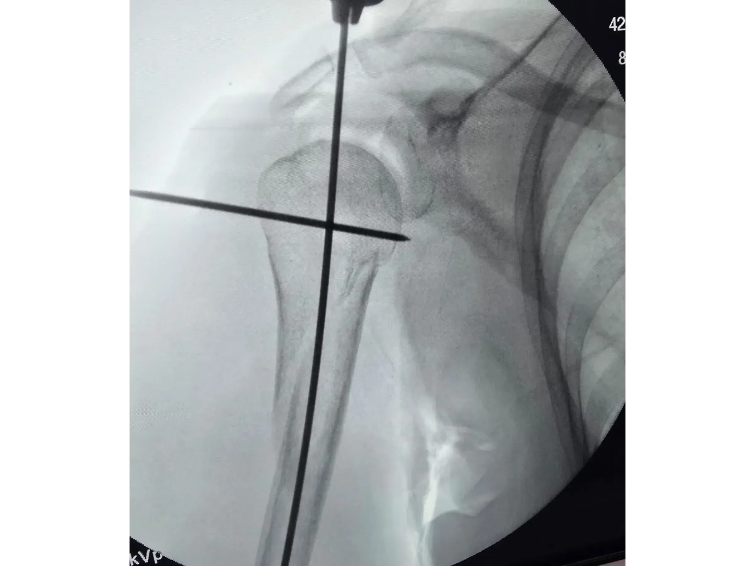 Haste Intramedular para Úmero Proximal (03)