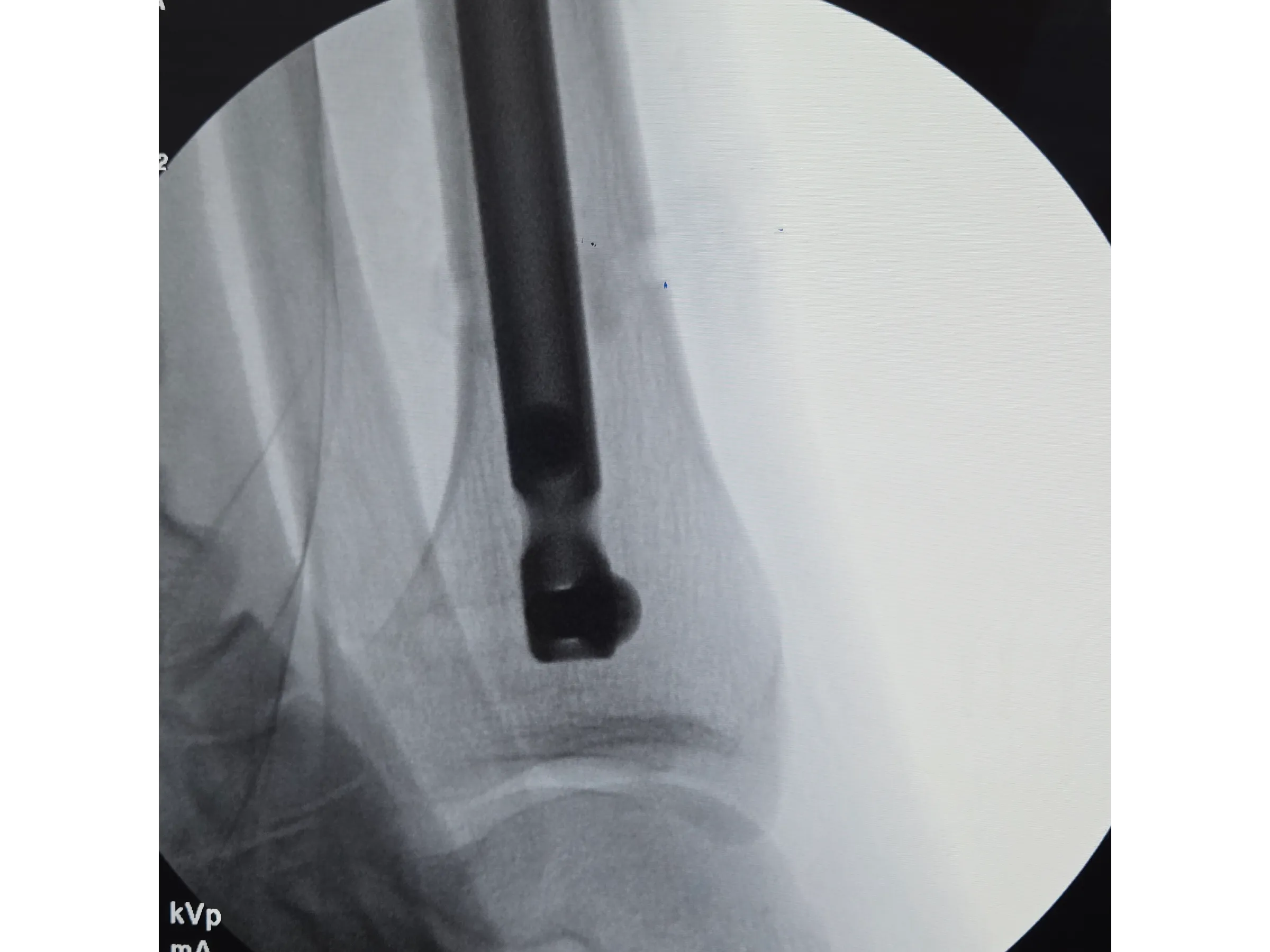 Haste Intramedular da Tíbia - Abordagem Infra-Patelar