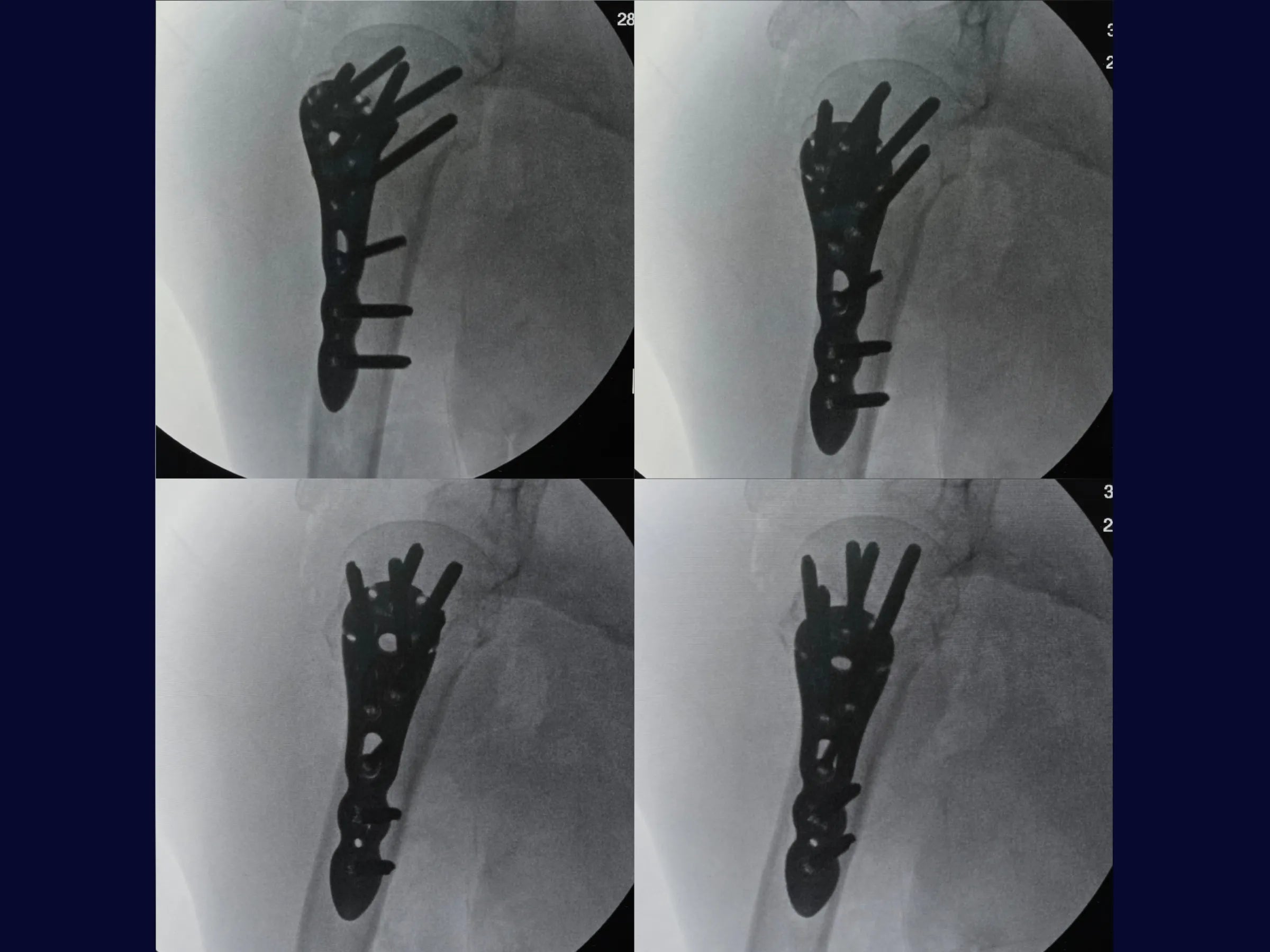 Úmero Proximal – Fratura em 4 Partes