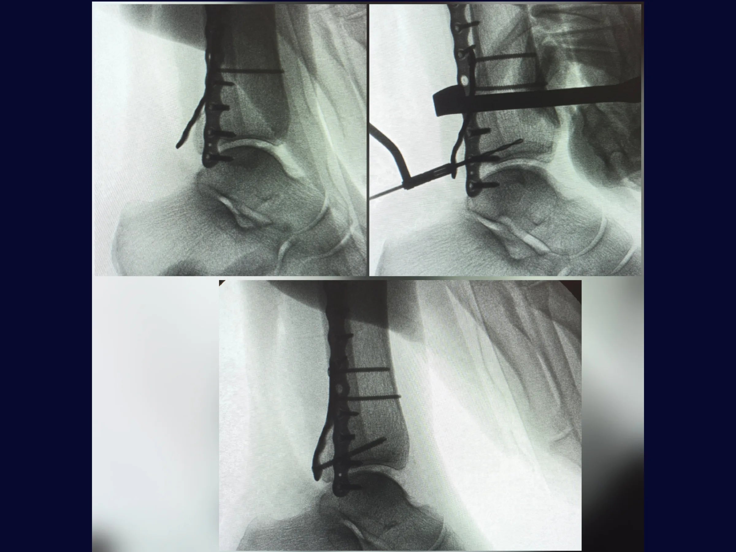 Fratura Trimaleolar - Abordagem em Decúbito Lateral