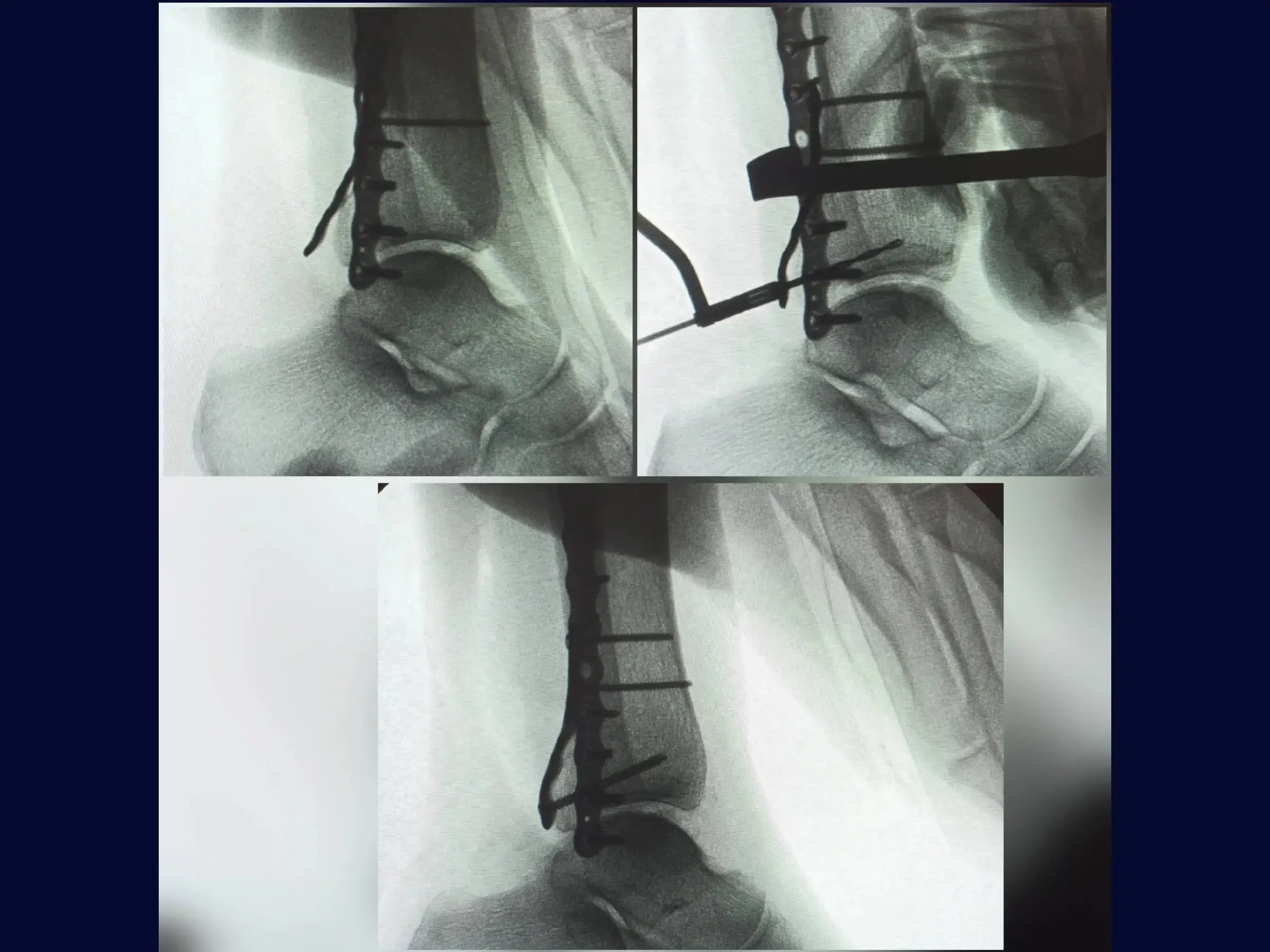Fratura Trimaleolar - Abordagem em Decúbito Lateral