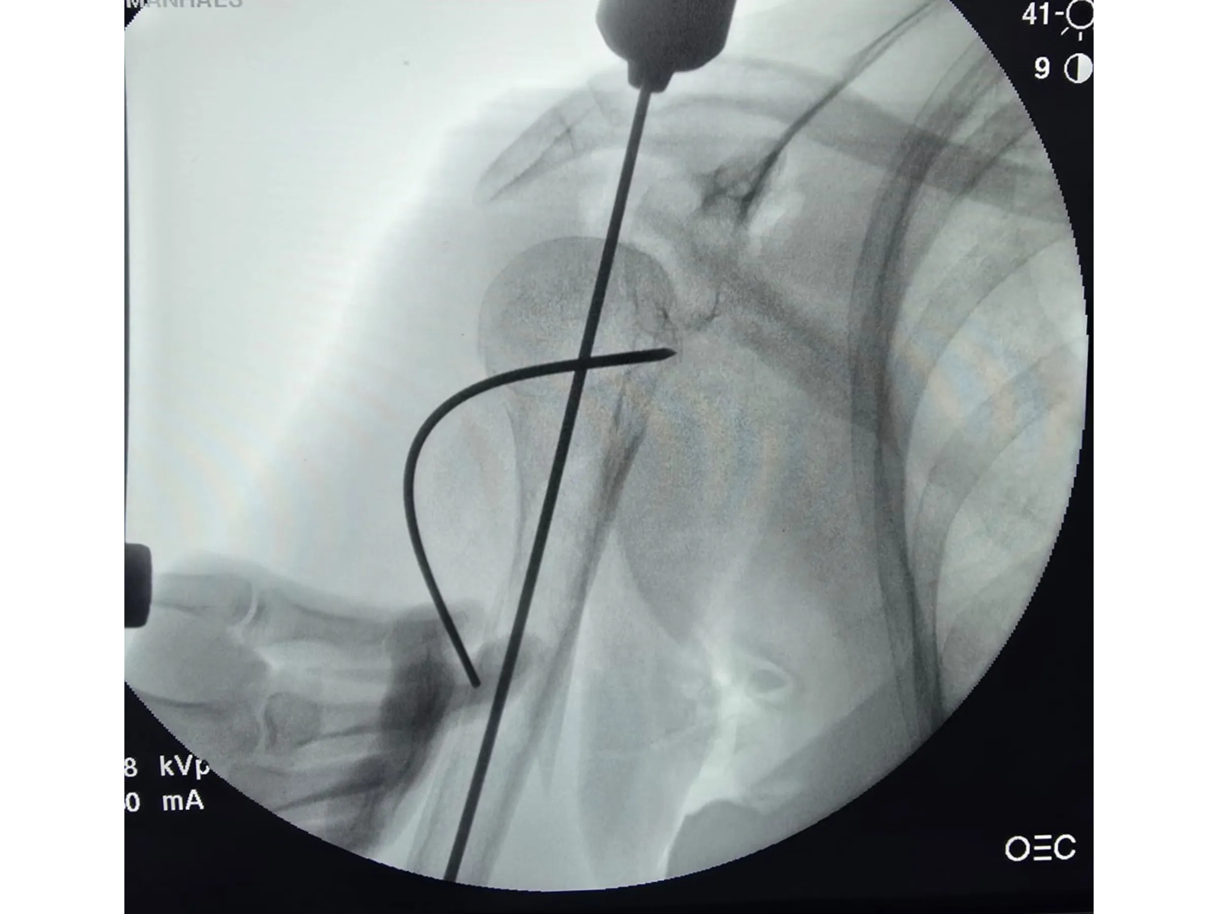 Intramedullary Nail for Proximal Humerus (03)