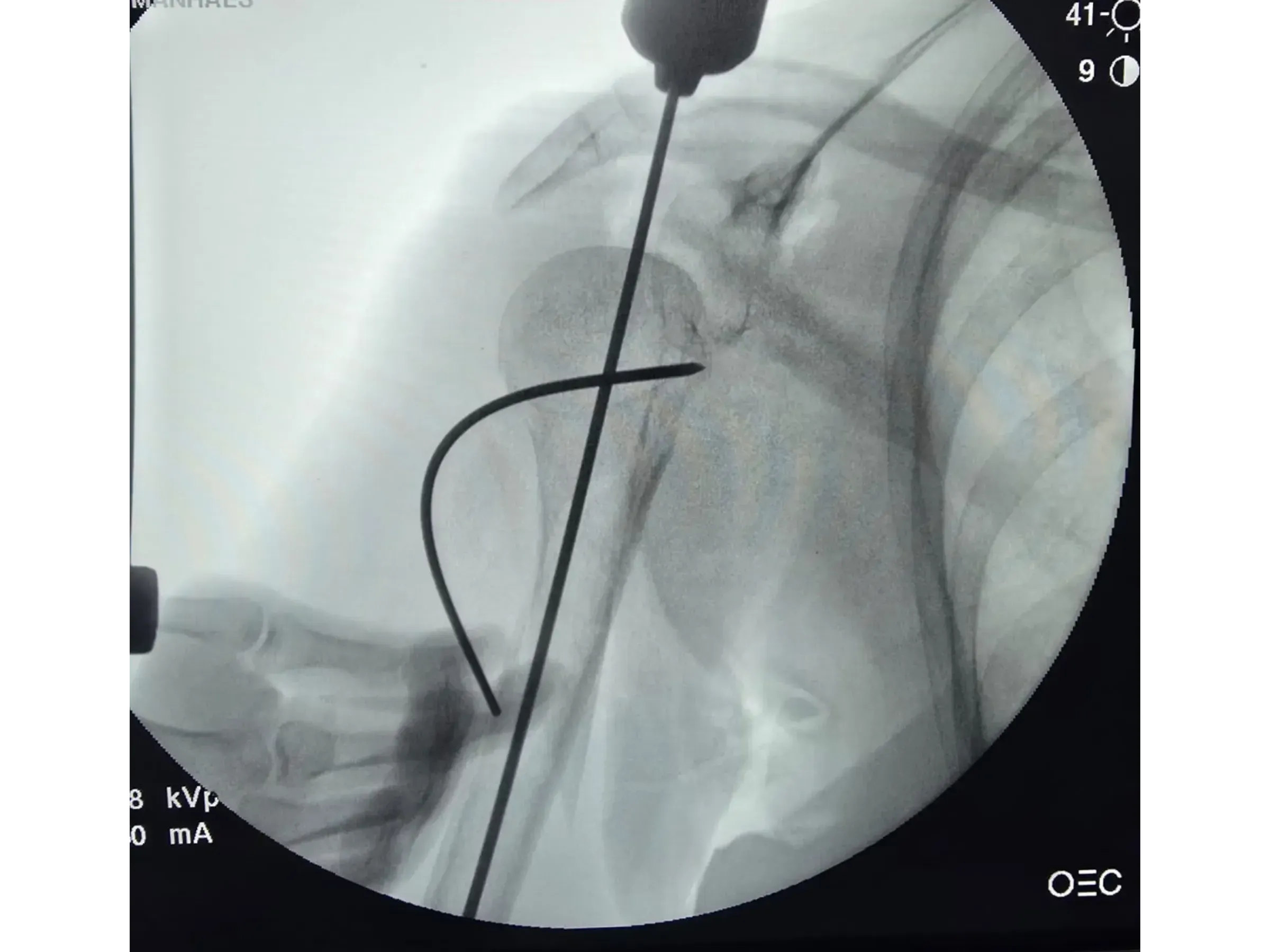 Haste Intramedular para Úmero Proximal (03)