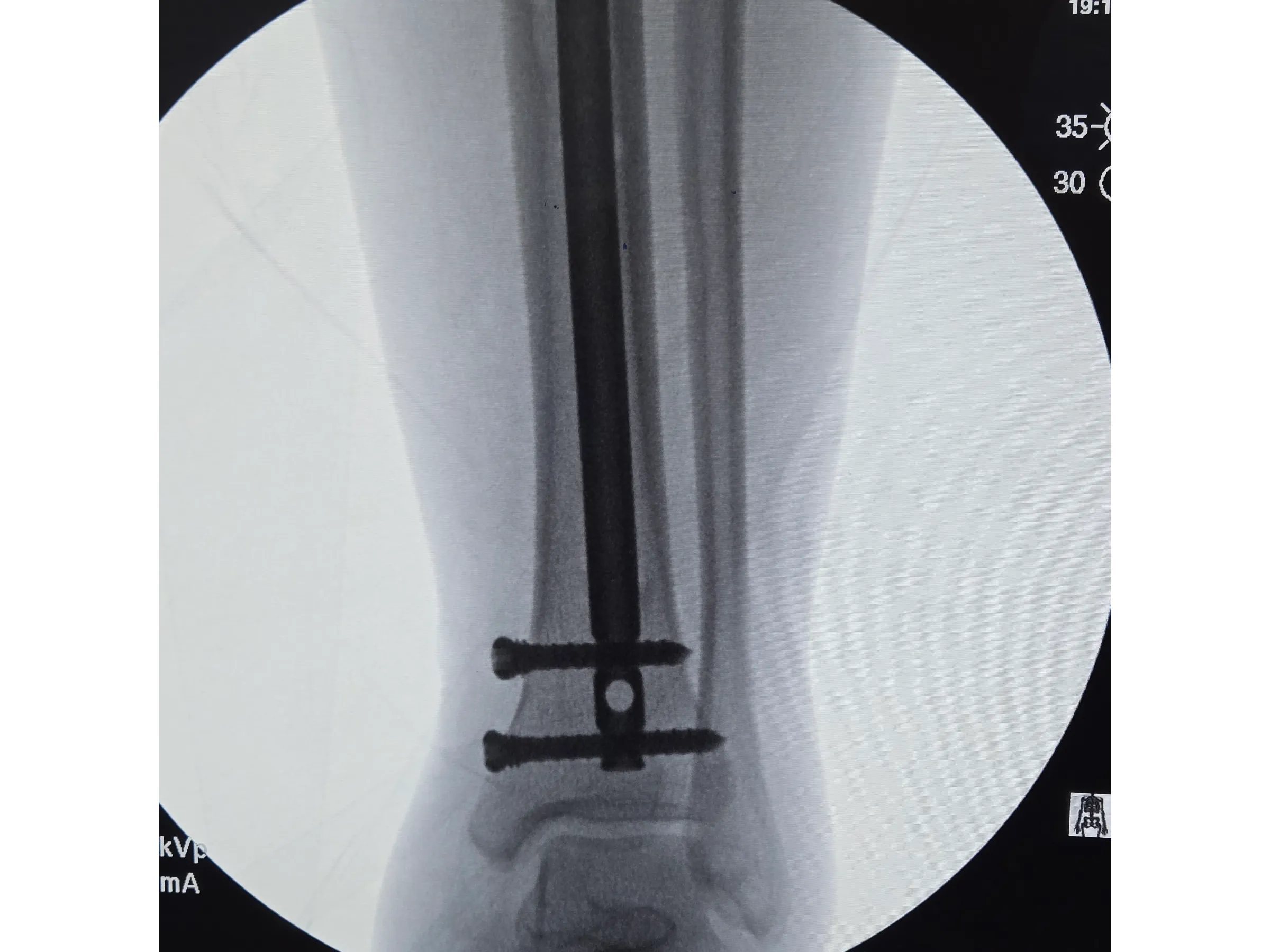 Haste Intramedular da Tíbia - Abordagem Infra-Patelar
