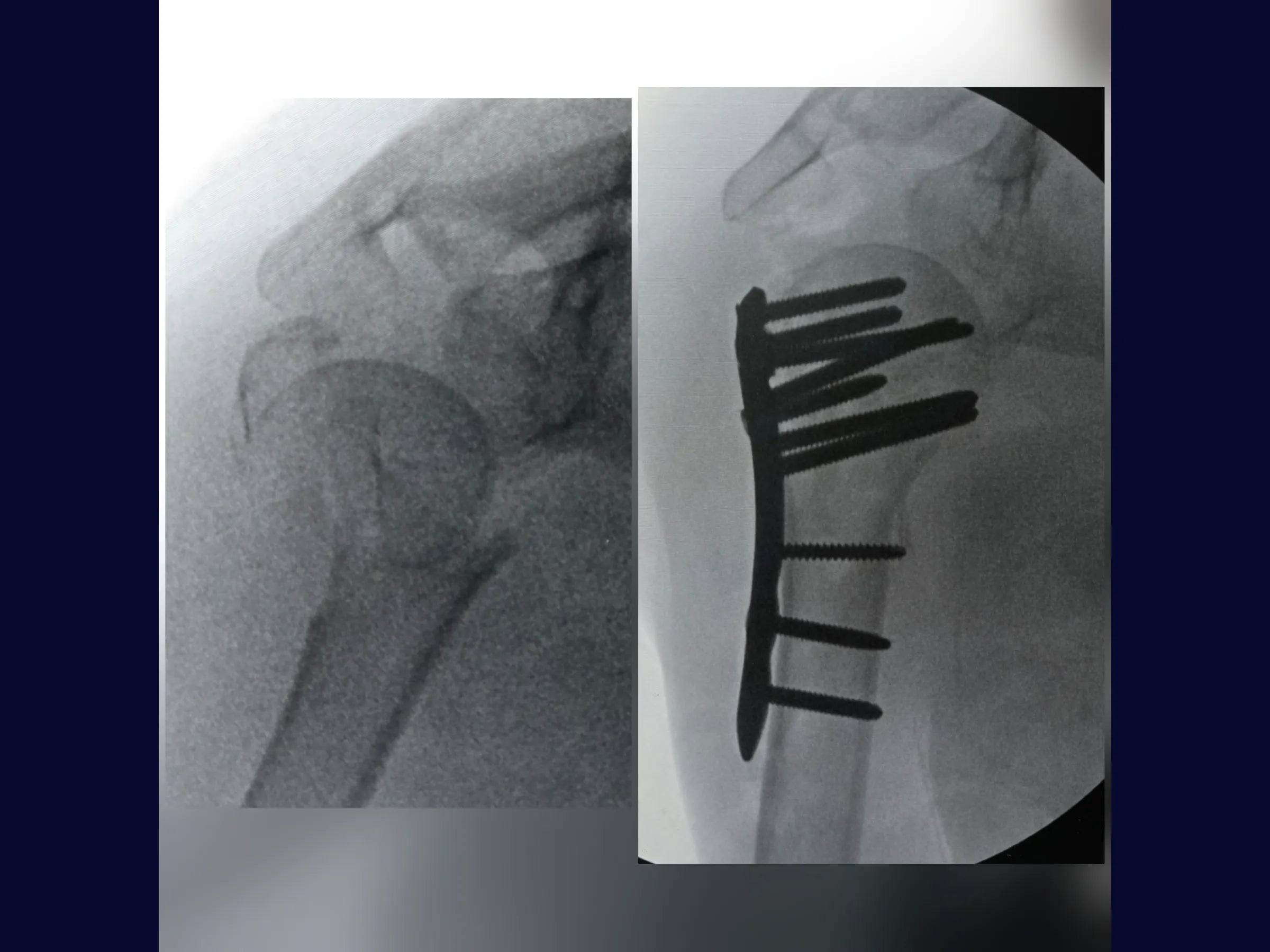 Úmero Proximal – Fratura em 4 Partes