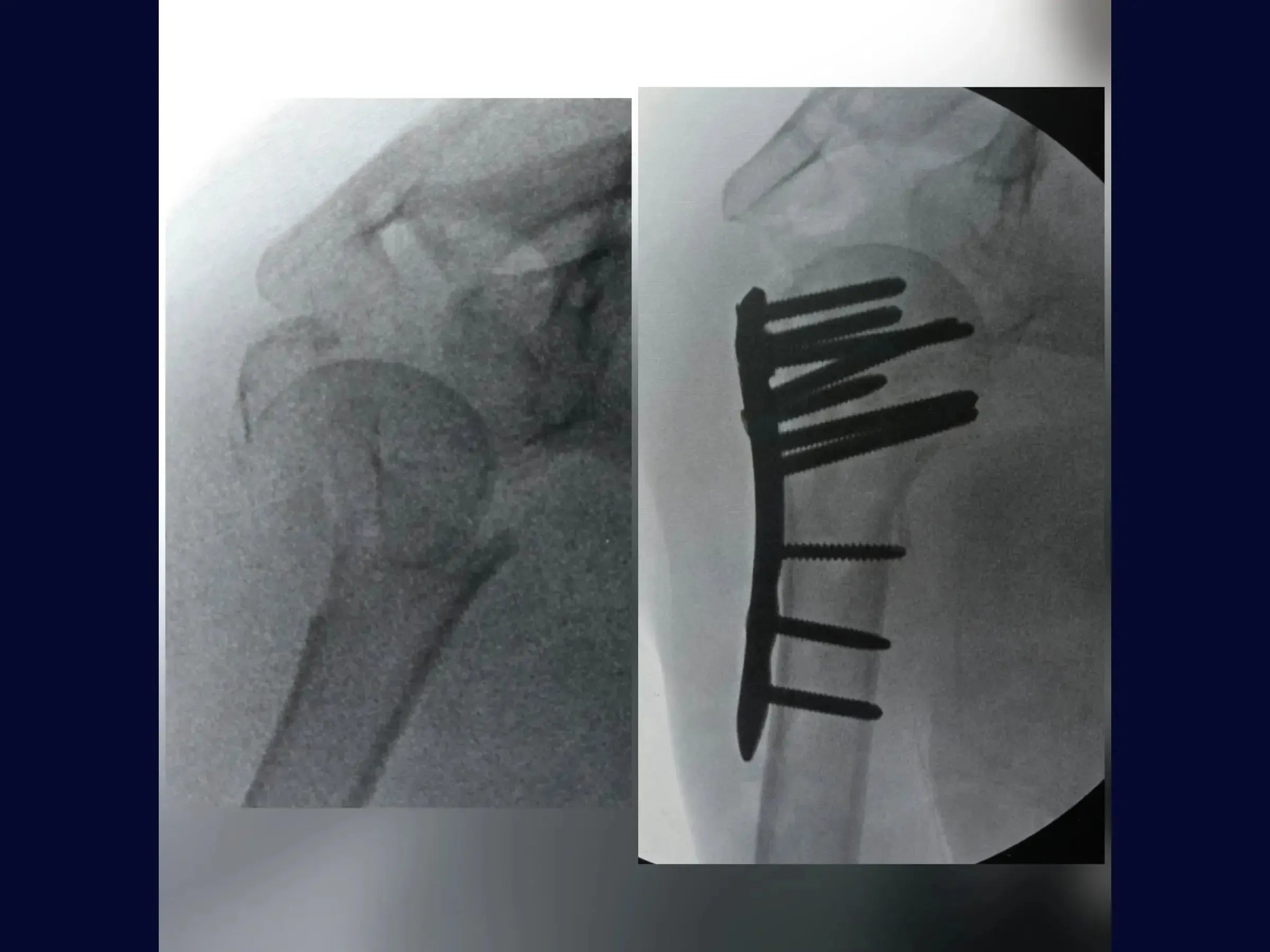 Úmero Proximal – Fratura em 4 Partes (05)