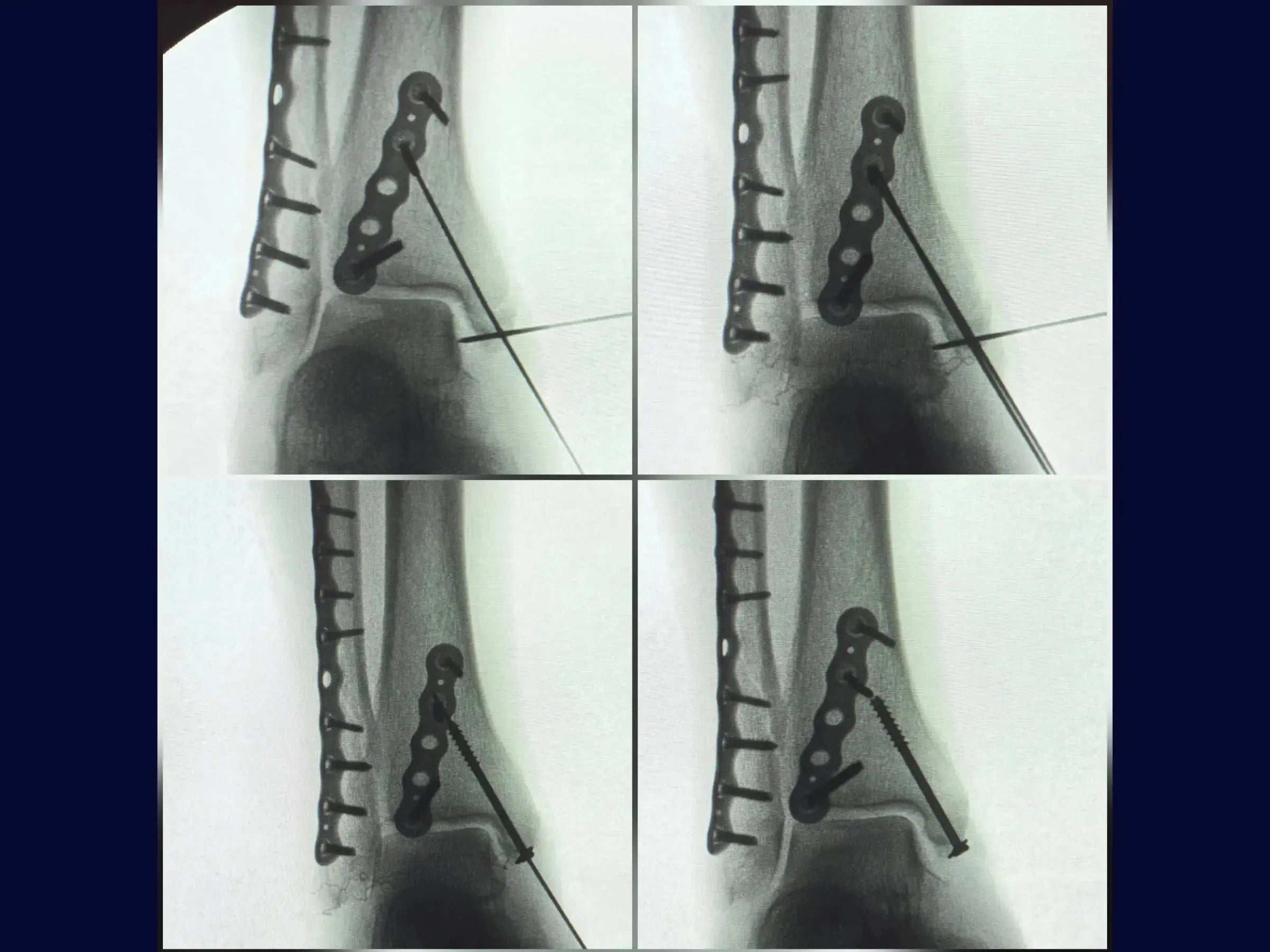Fratura Trimaleolar - Abordagem em Decúbito Lateral