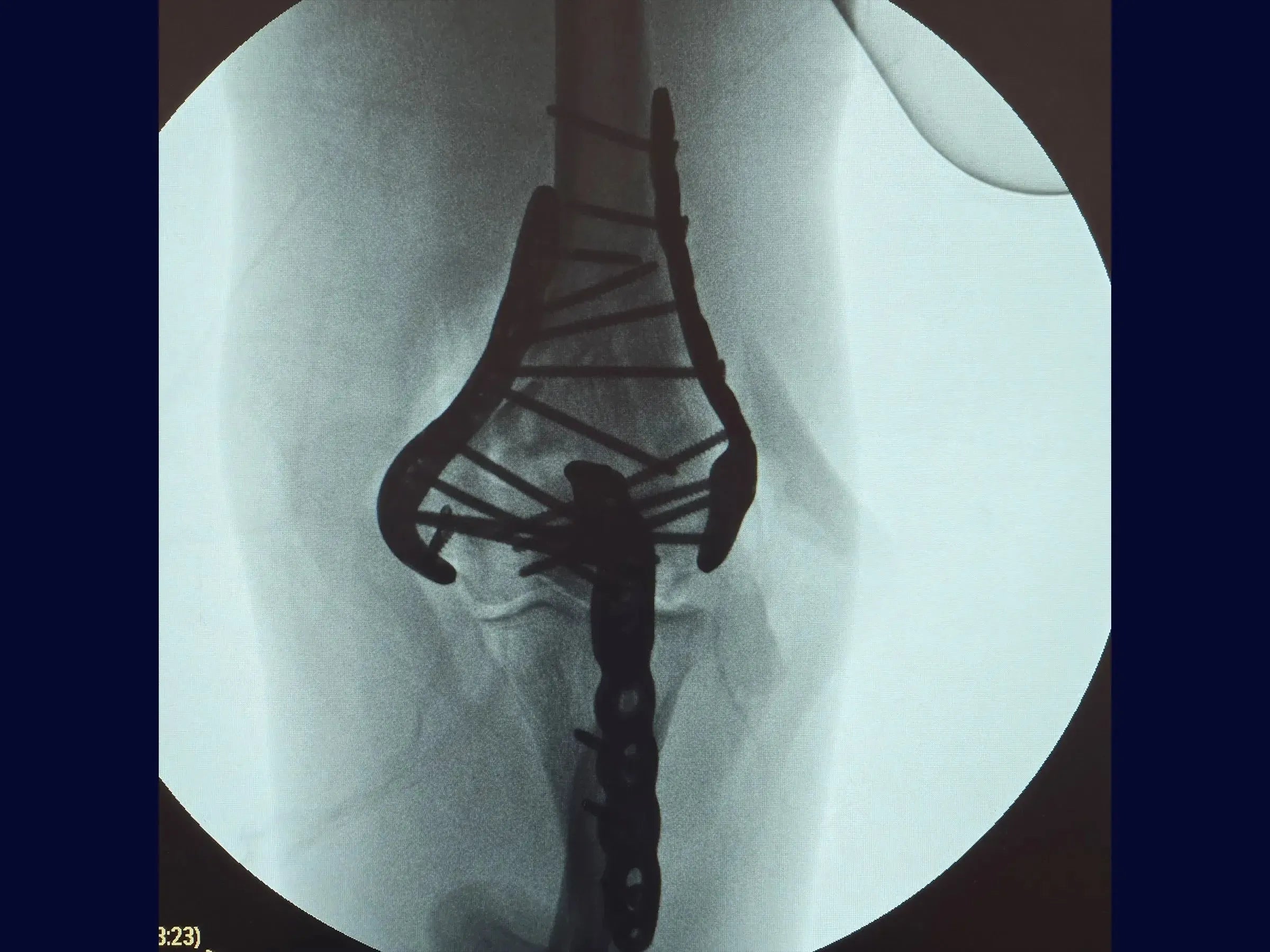Comminuted Articular Fracture of the Distal Humerus