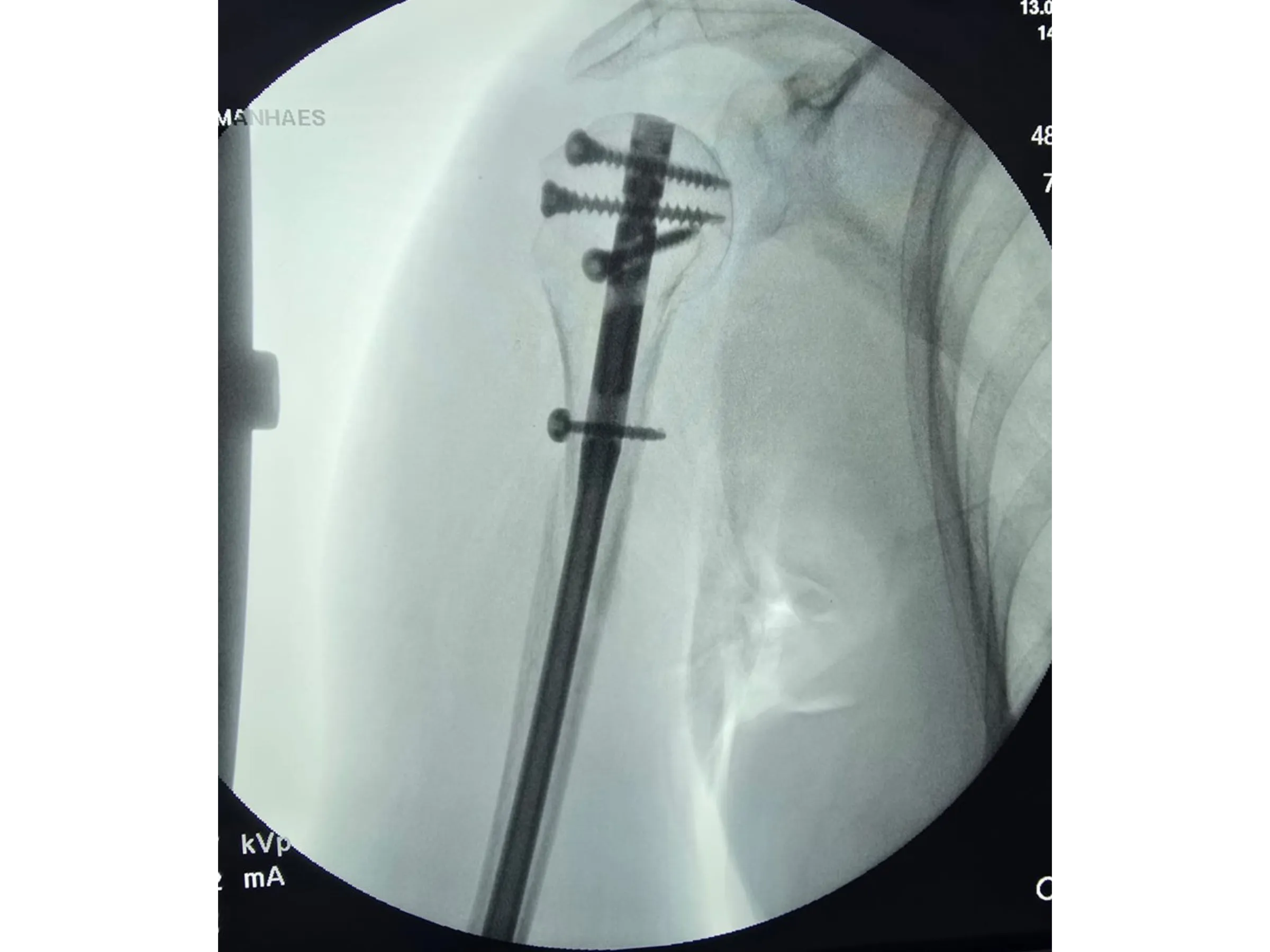 Intramedullary Nail for Proximal Humerus (03)