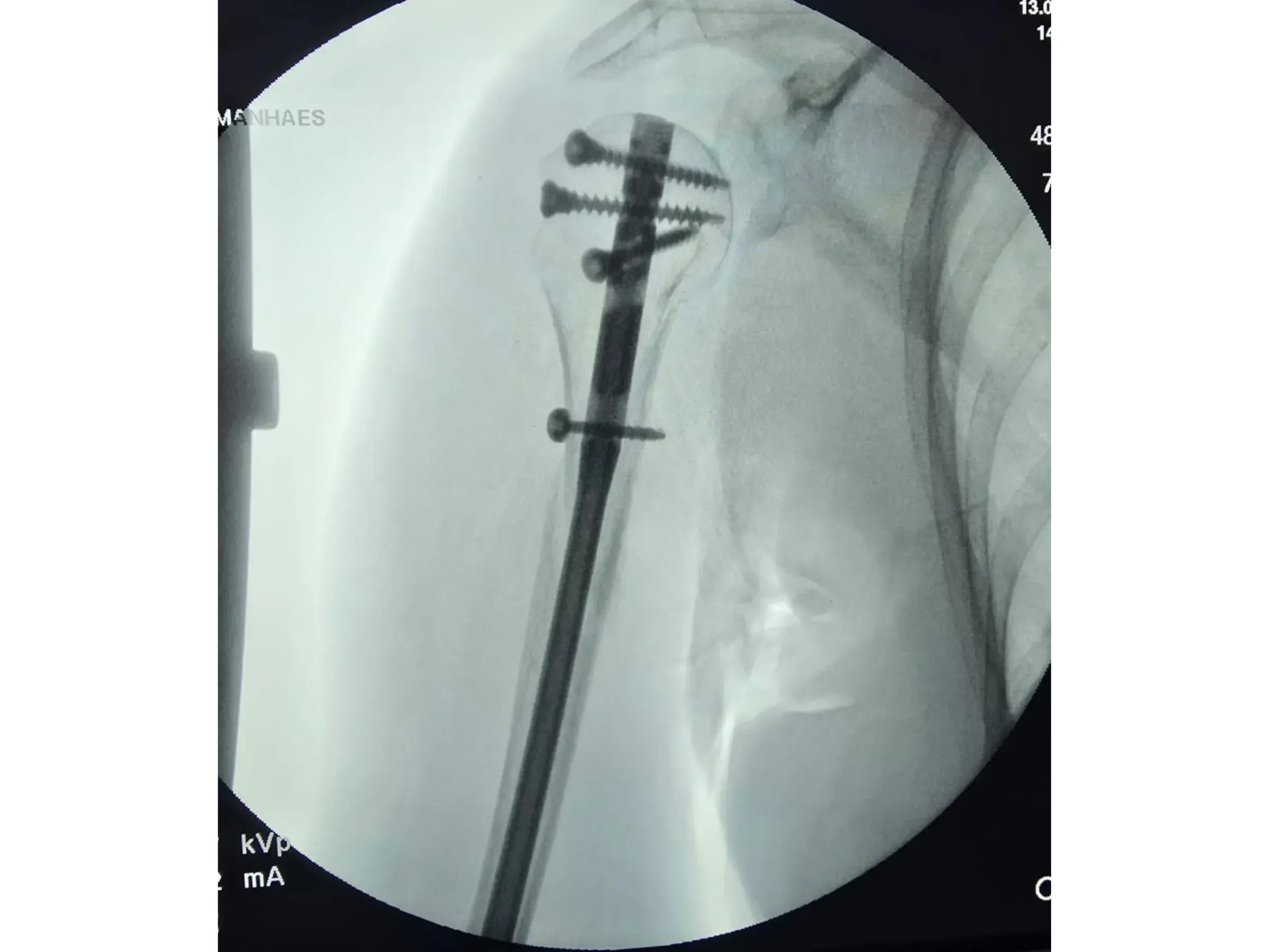 Haste Intramedular para Úmero Proximal (03)
