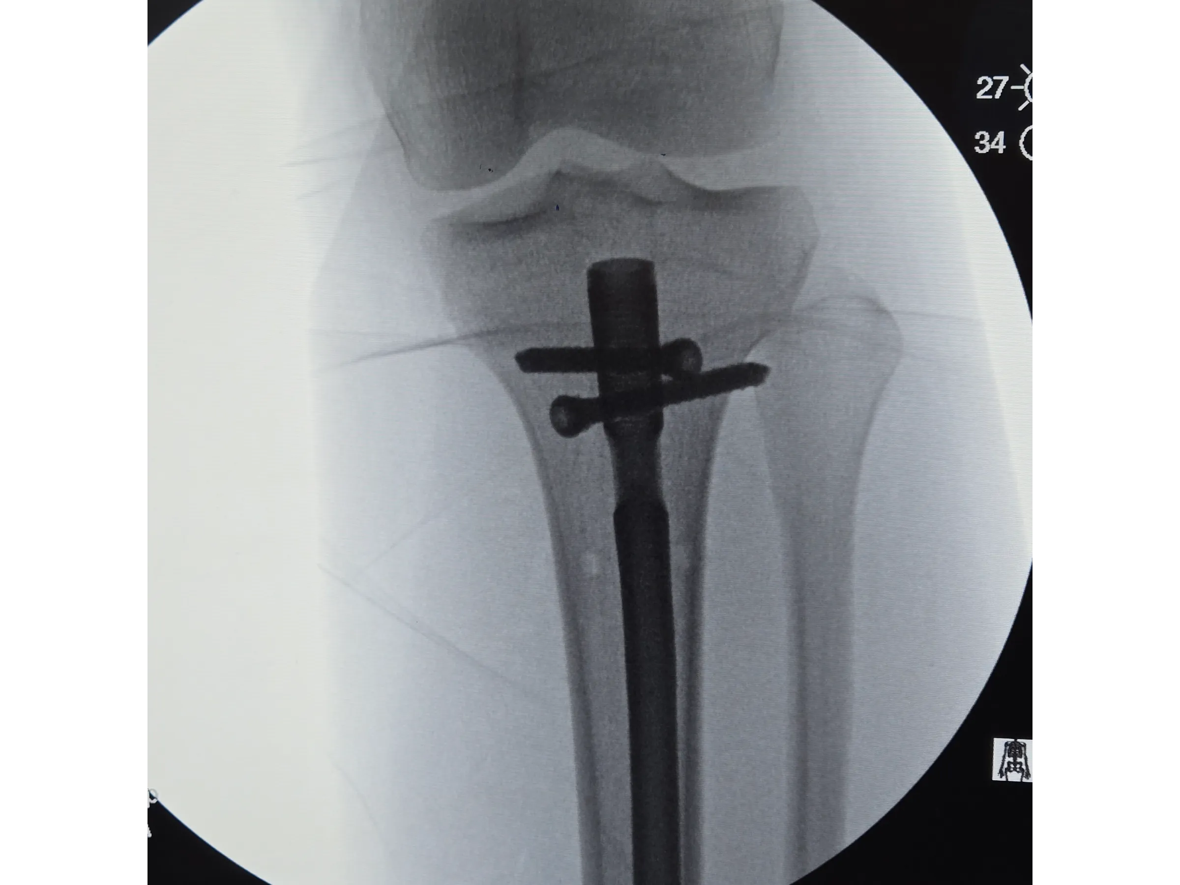 Haste Intramedular da Tíbia - Abordagem Infra-Patelar