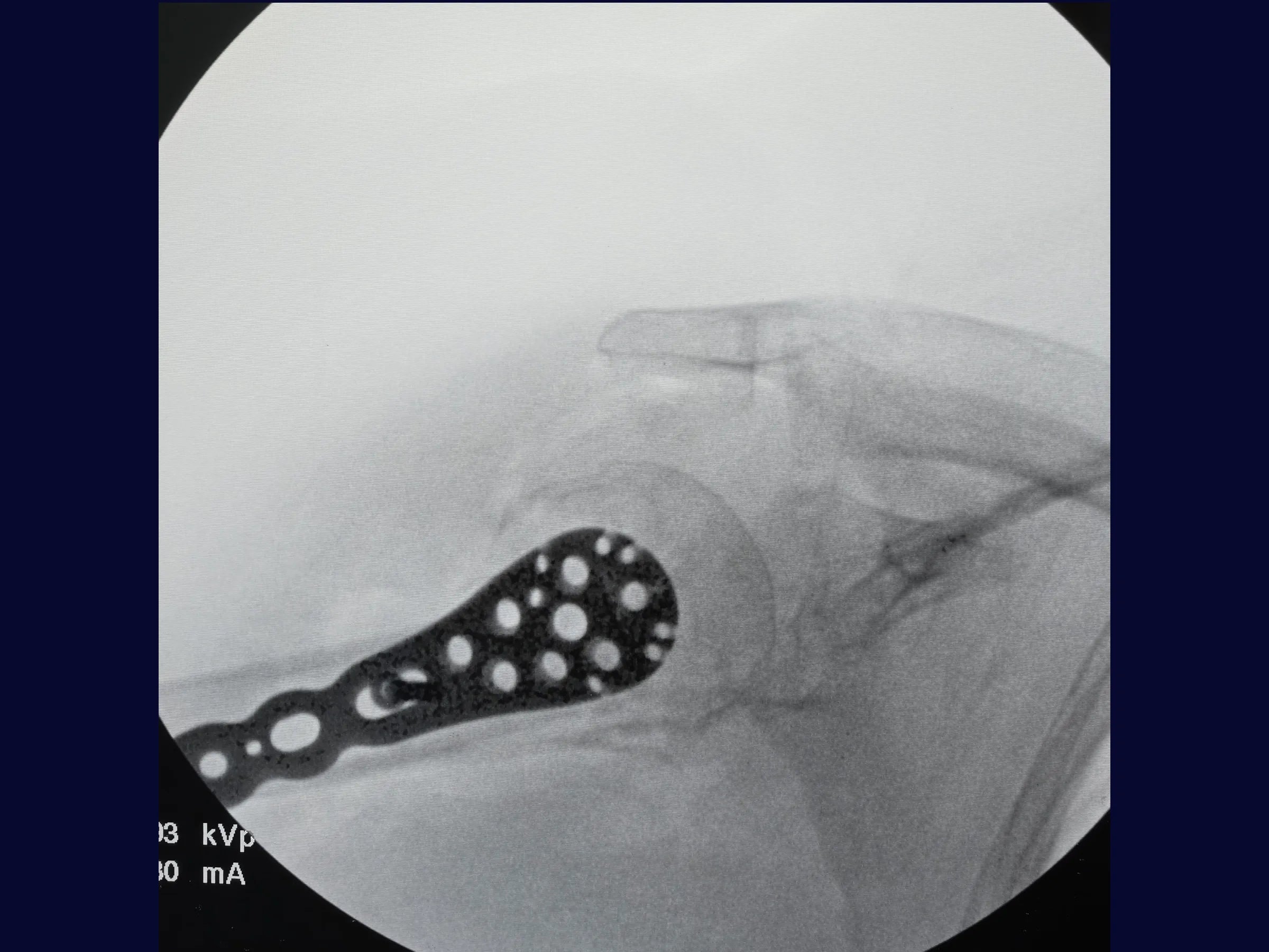Úmero Proximal – Fratura em 4 Partes