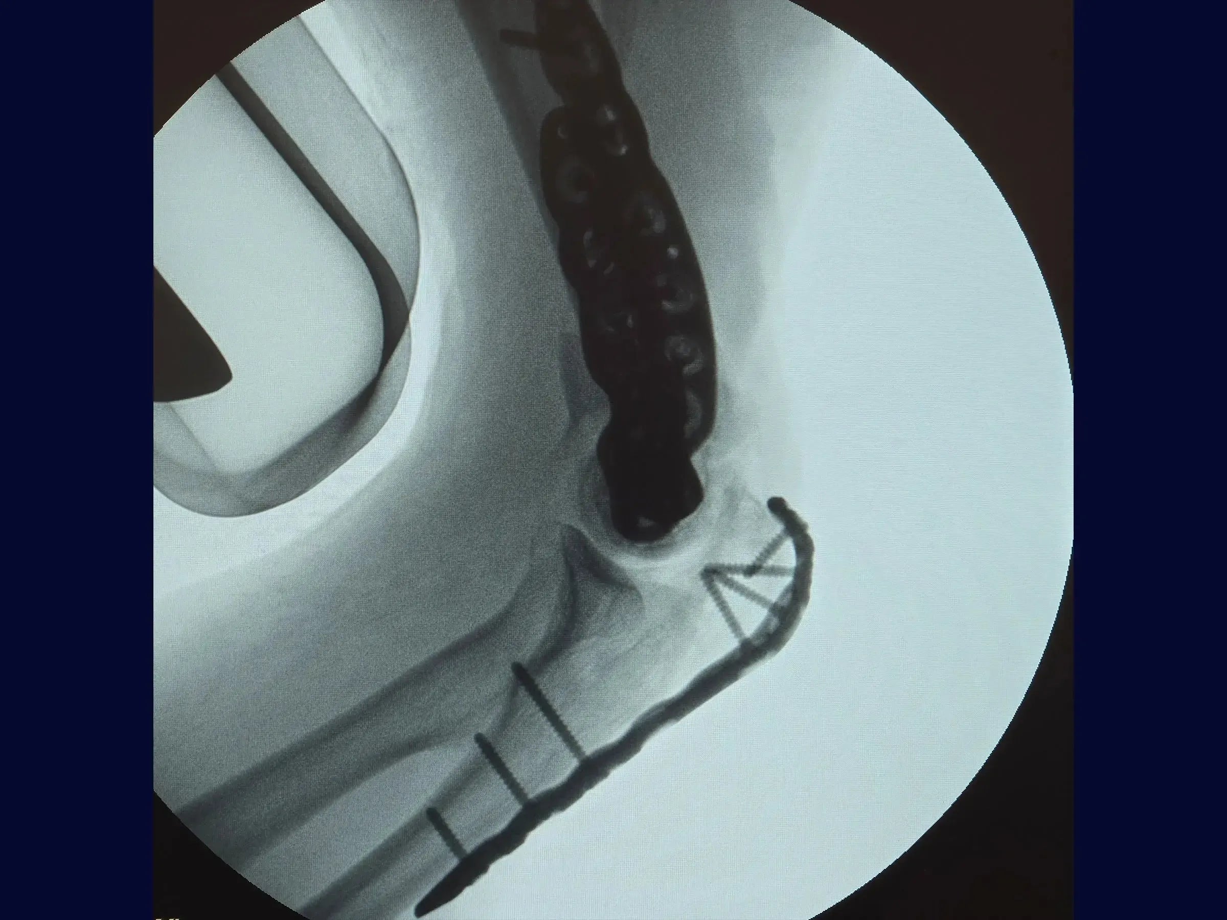 Comminuted Articular Fracture of the Distal Humerus