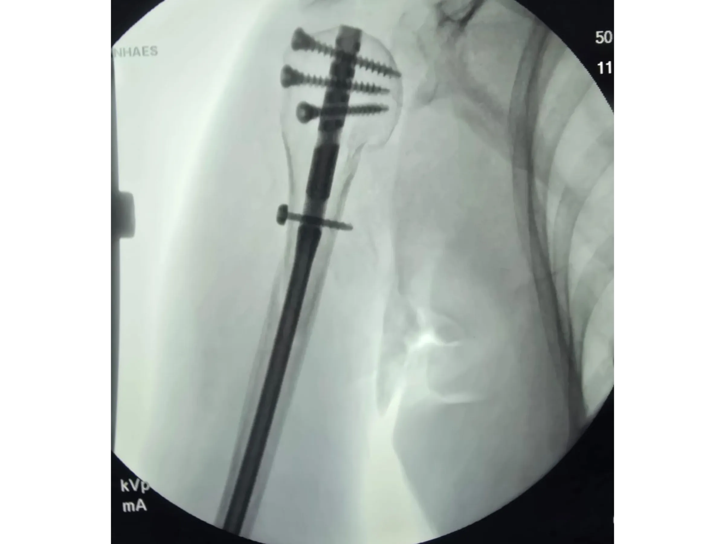 Intramedullary Nail for Proximal Humerus (03)