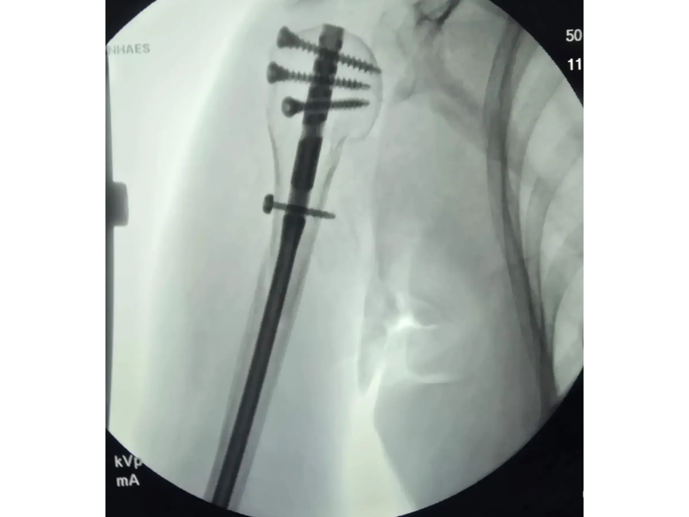 Haste Intramedular para Úmero Proximal (03)