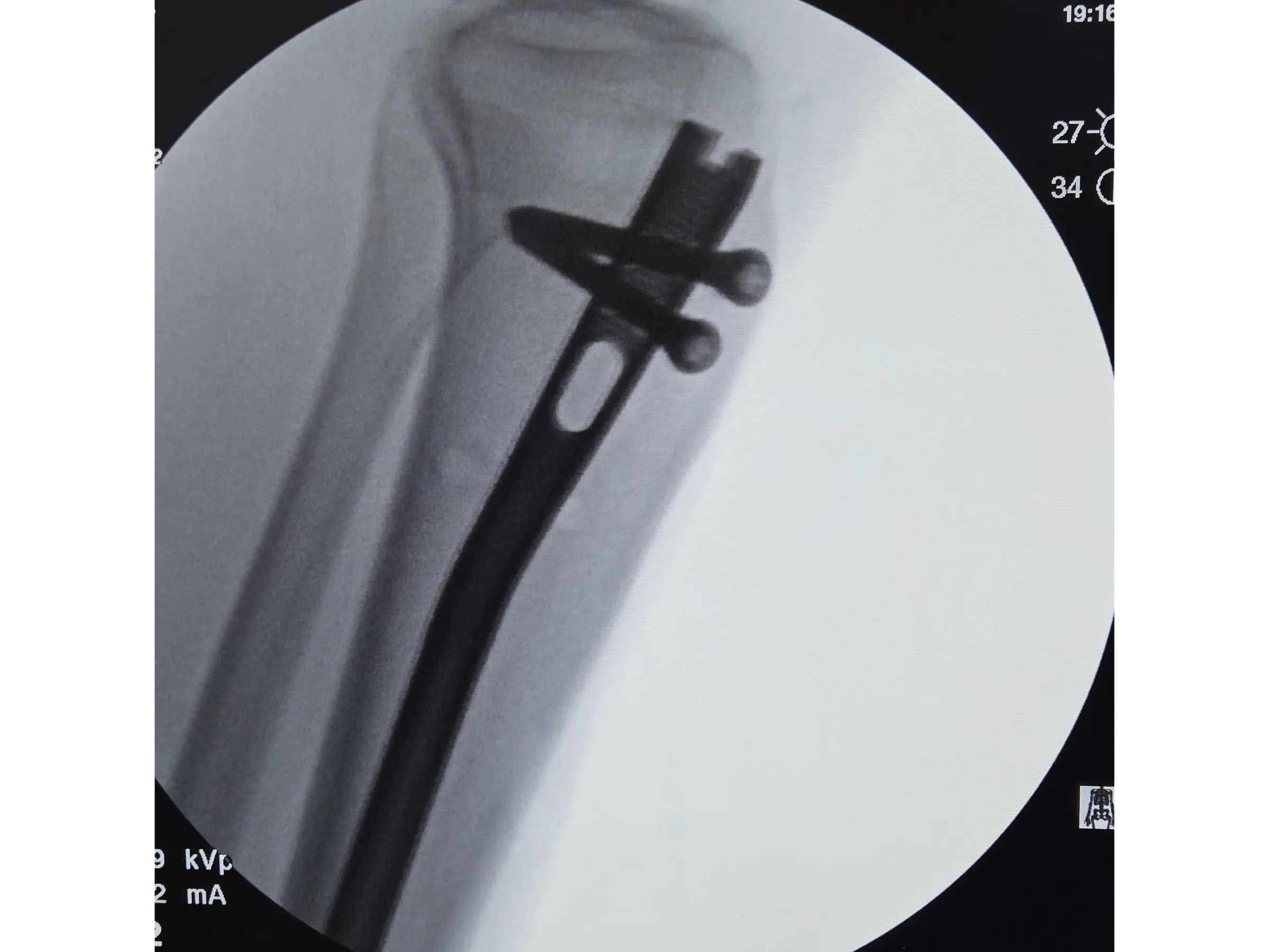 Haste Intramedular da Tíbia - Abordagem Infra-Patelar