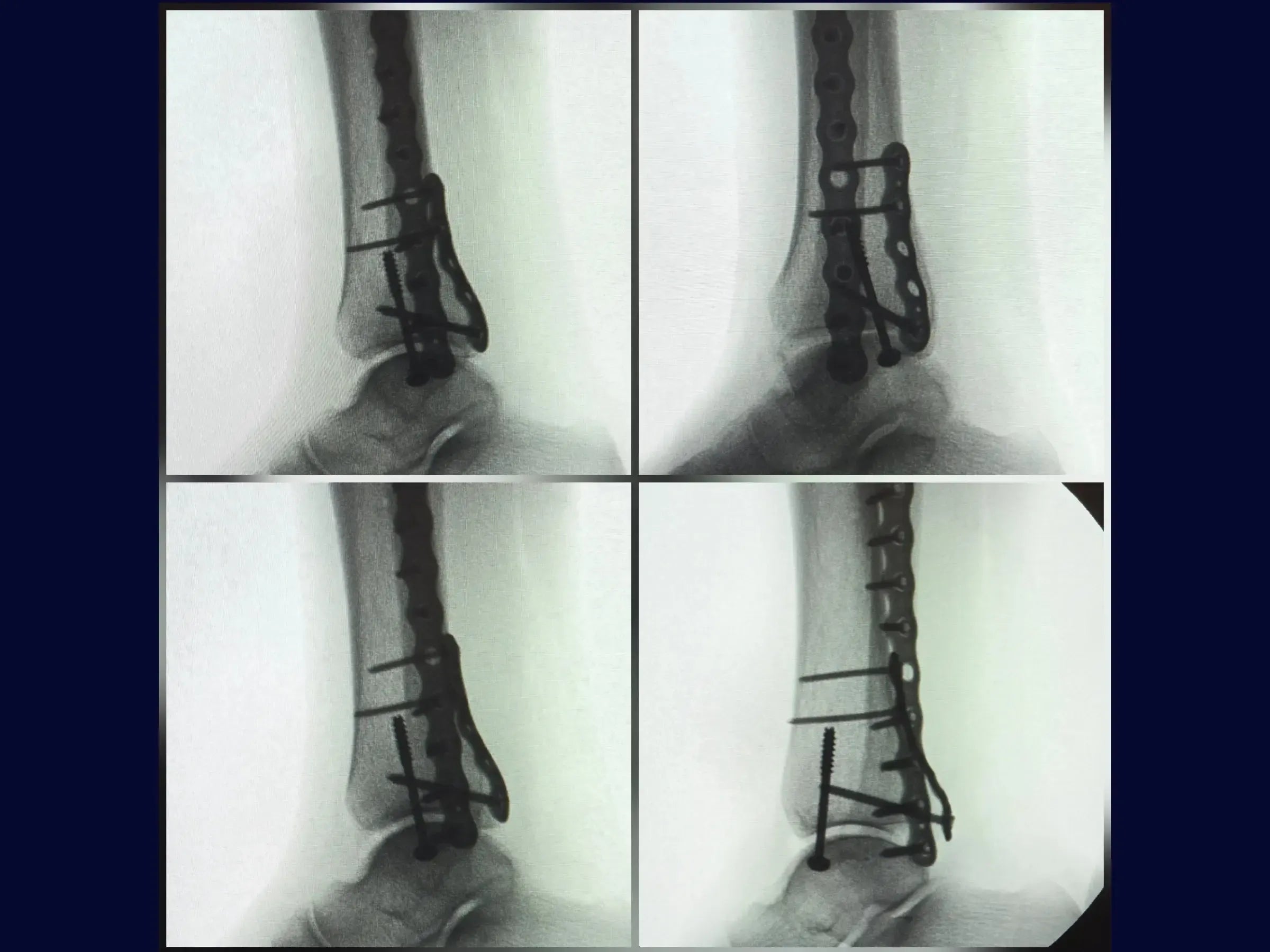 Fratura Trimaleolar - Abordagem em Decúbito Lateral