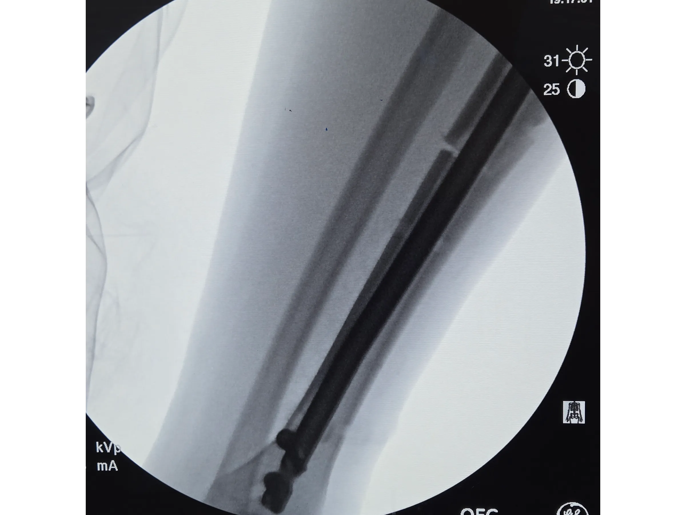 Haste Intramedular da Tíbia - Abordagem Infra-Patelar